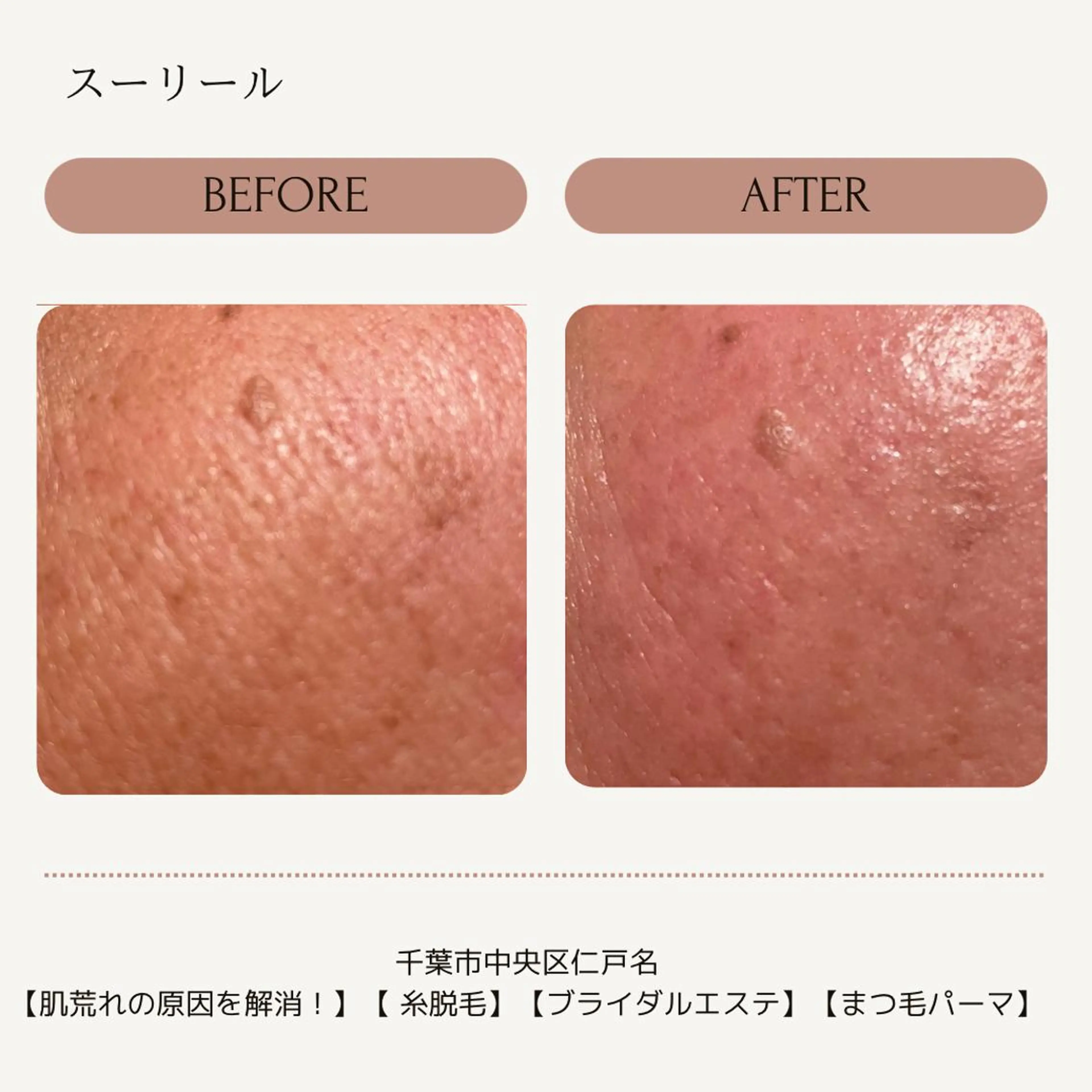 エステ 肌荒れに悩む方のため オイルフリーサロンのマツエク・マツパデザイン