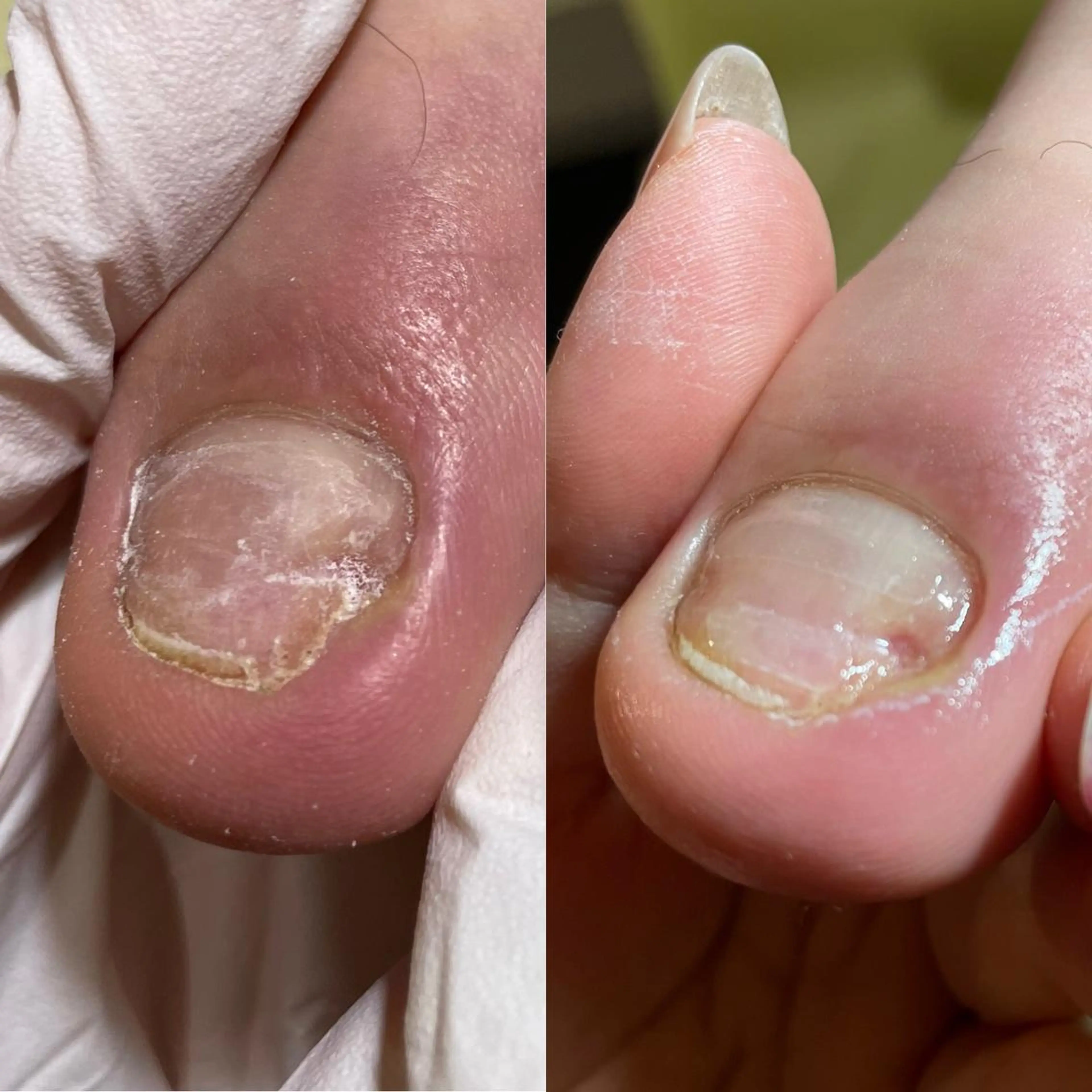 深爪・噛み爪・トラブルケア、爪の矯正　　　　　　カウンセリング込み。どんな小さいお悩みでも一度ご相談ください。の写真