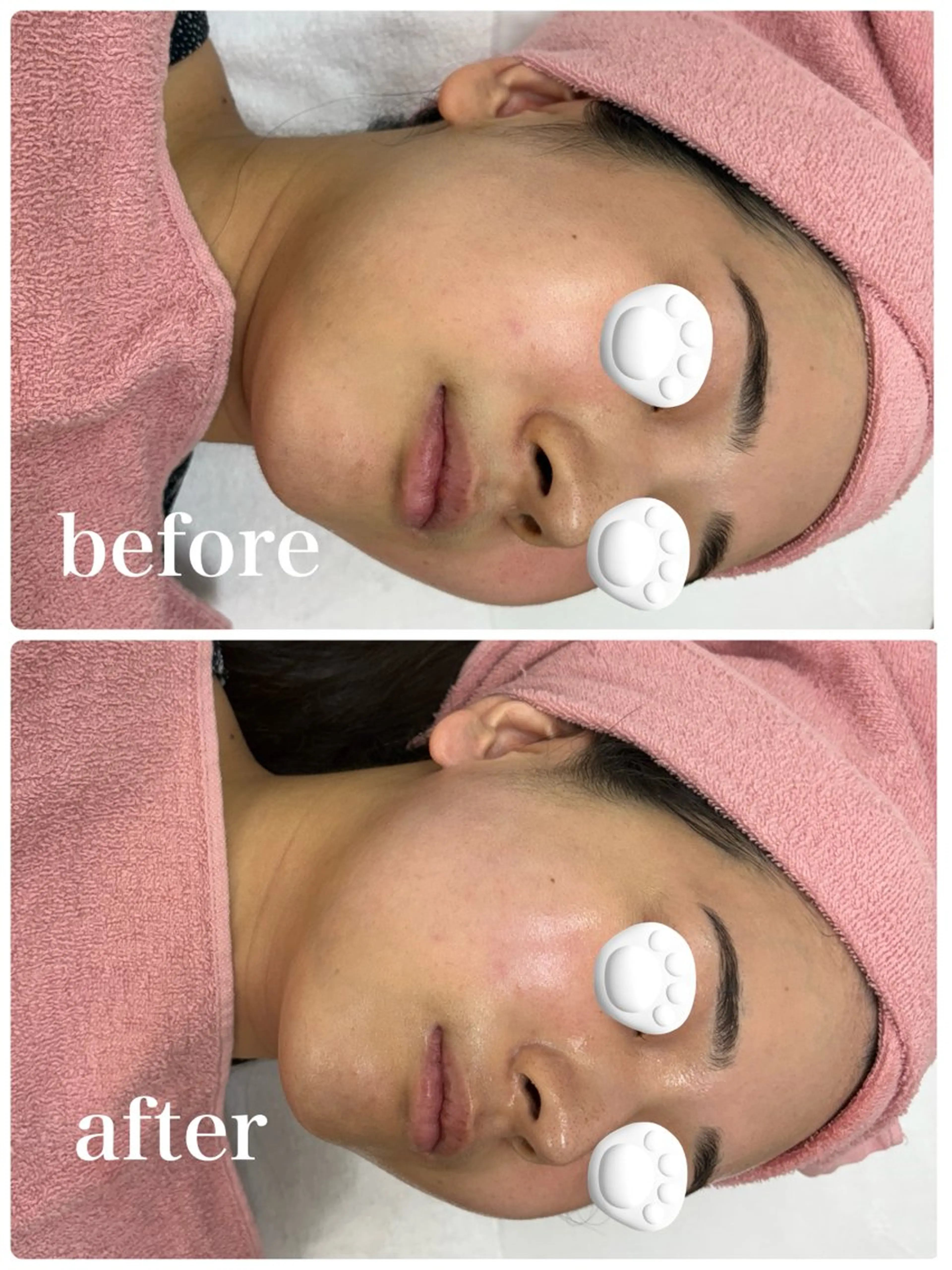 【ミニモ限定✨小顔ケア】EMSフェイスラインスッキリ¥2,500の写真