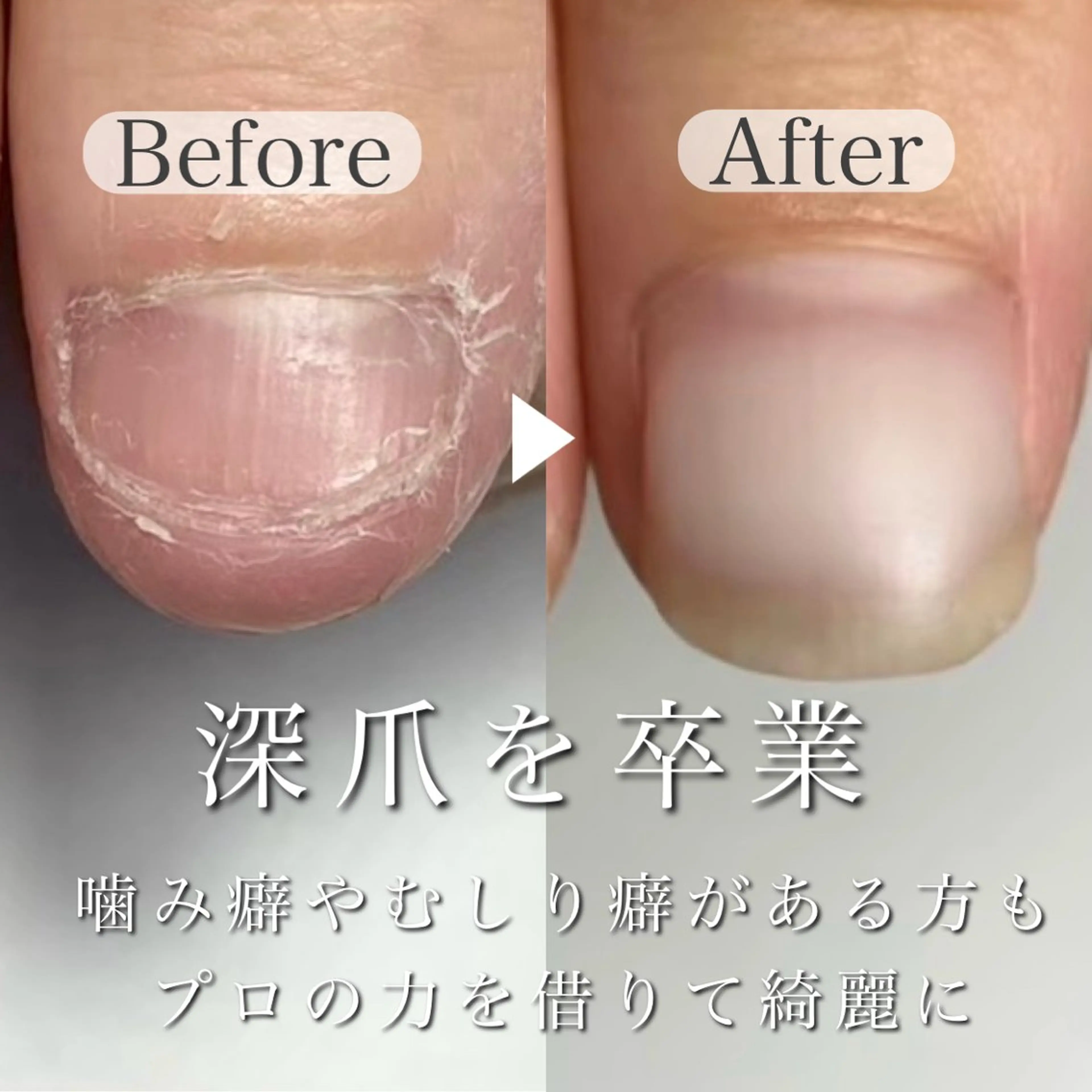 ◎噛み癖・むしり癖をやめる！自爪育成スタートコースの写真