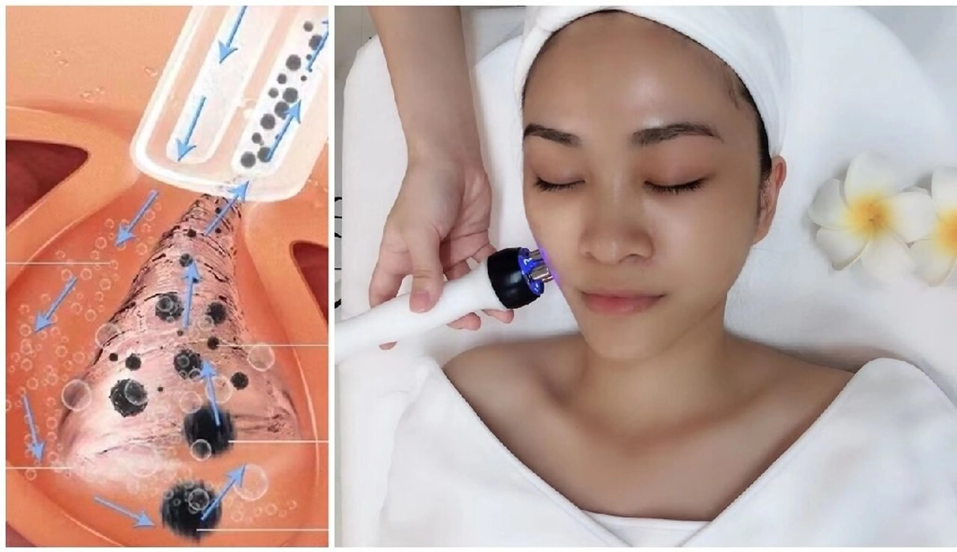 毛穴角栓・黒ずみ洗浄ハイドロフェイシャル+ハイパ-＋ハンド¥7980→¥5980の写真