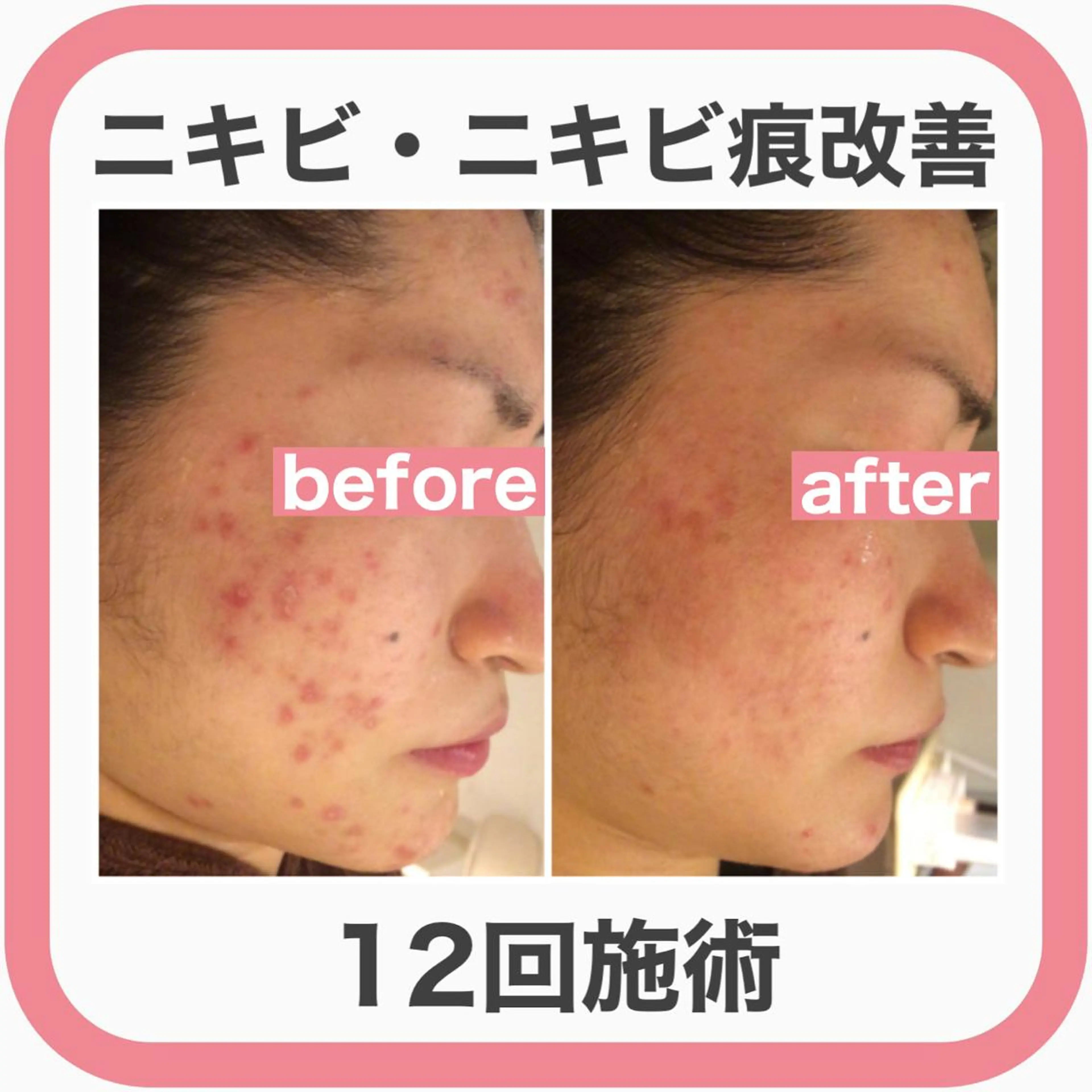 ミディアム カラー パーマ ヘアアレンジ メンズ キッズ ネイル マツエク・マツパ エステ リラク ニキビ・肌質改善専門 ♡人生が変わるサロンのエステ・リラクイメージ