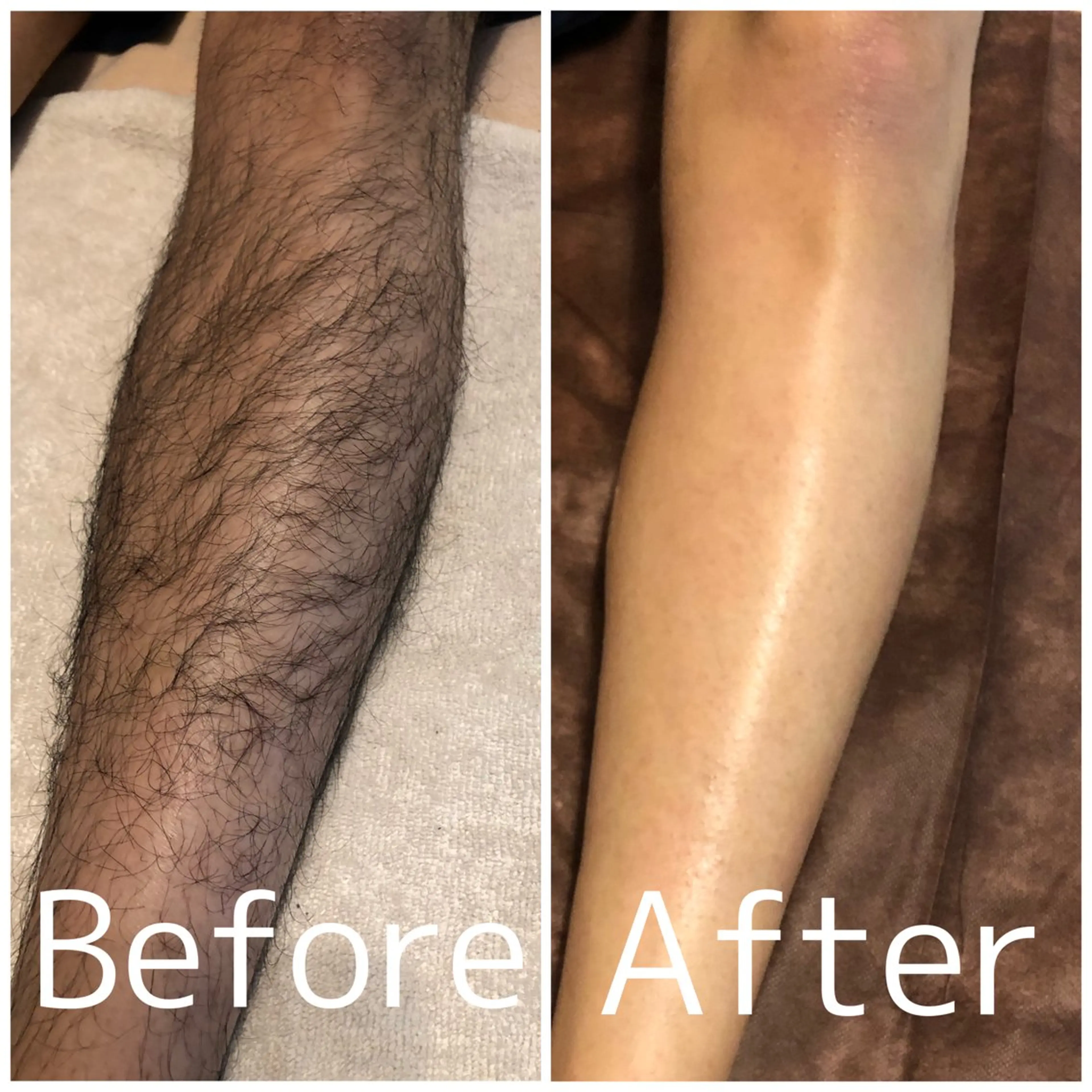 ミニモ学割⭐︎ ヒゲ脱毛通常¥6,600→¥3,500の写真