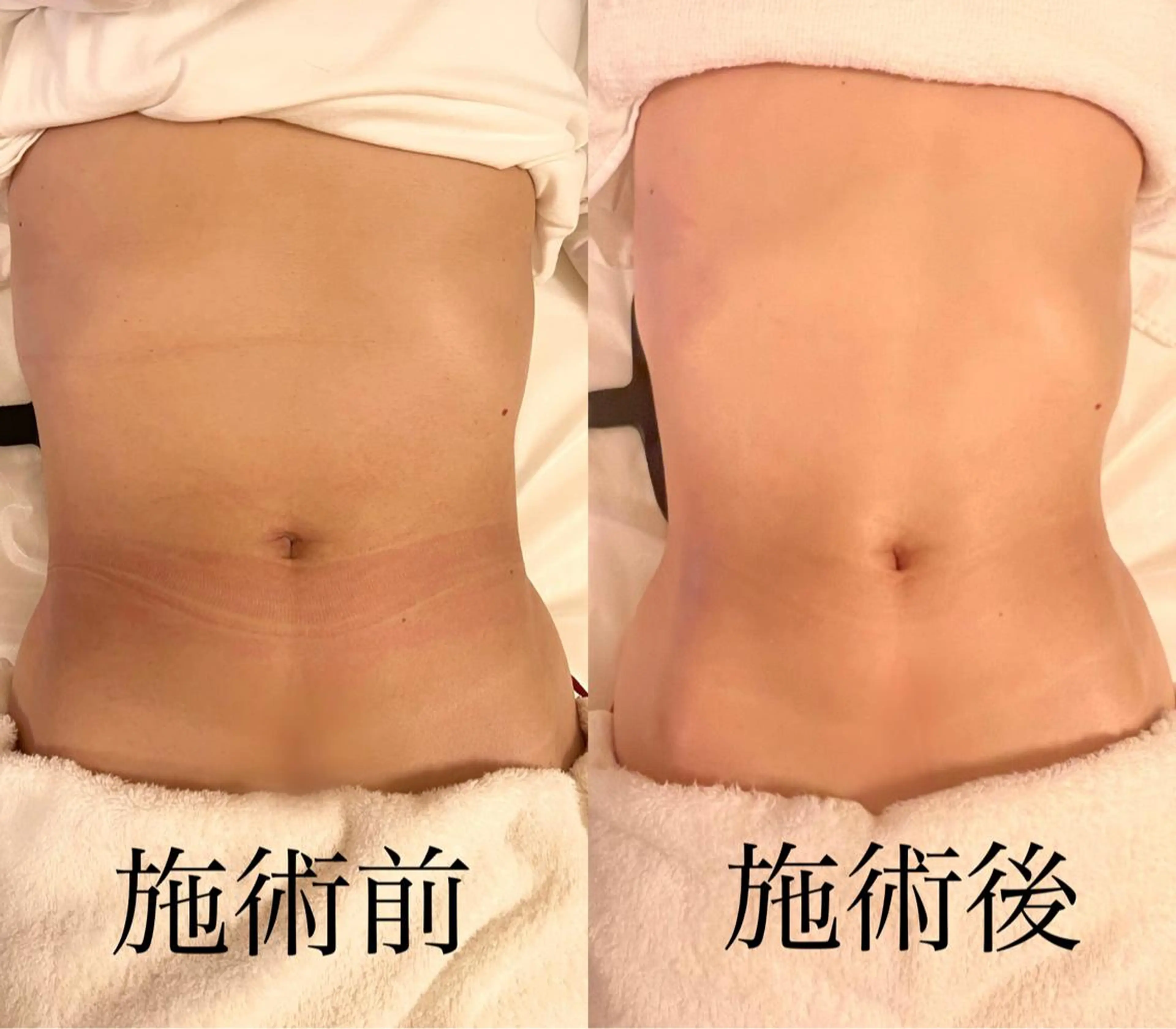 WOM SALON所属・MIKU【美容整形ダ ウンタイムケア銀座】のエステ・リラクイメージ