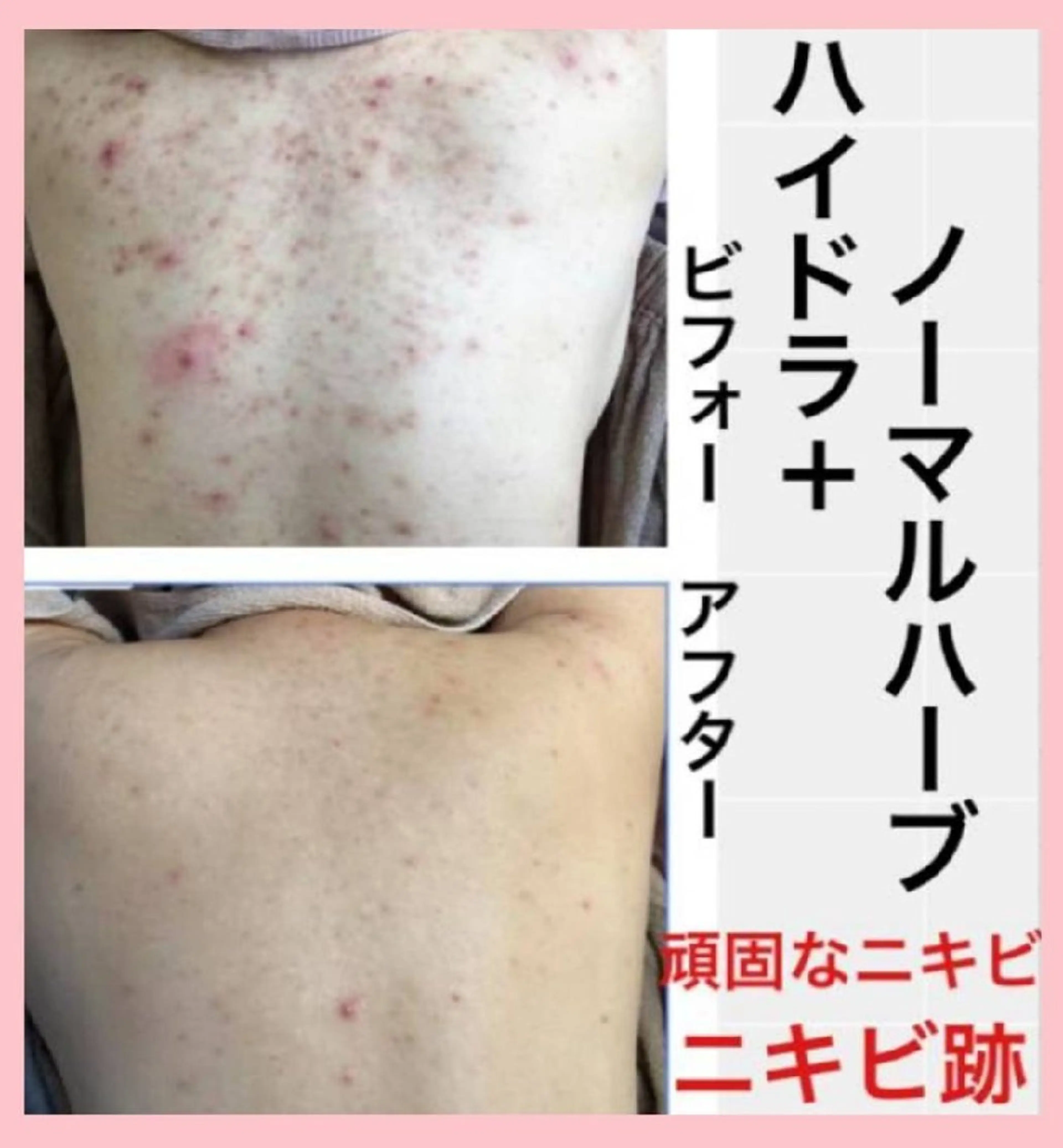 🌿Bodyハーブピーリング&美容洗浄🌿剥離ありハード背中、腰、二の腕、お尻、デコルテ等🩵吹き出物、吹き出物跡、色跡の写真