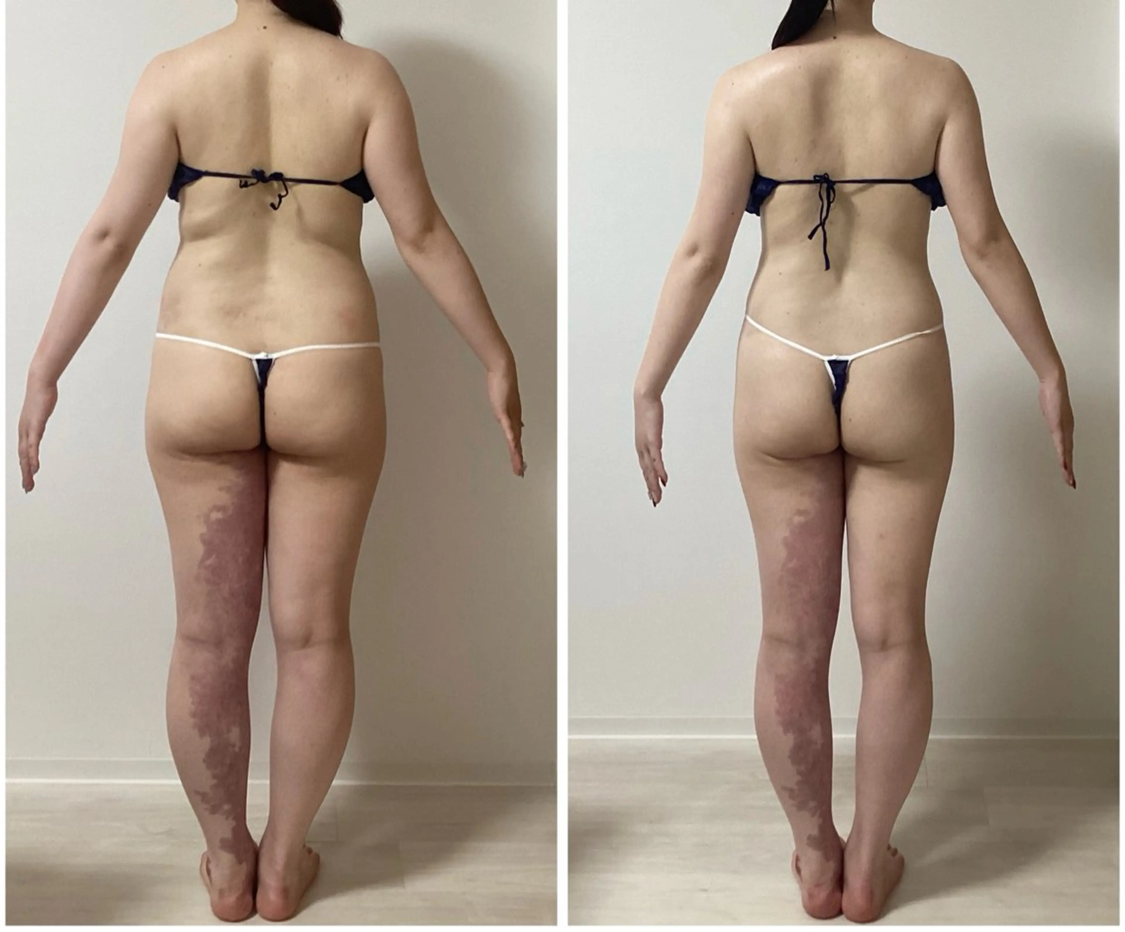 エステ ハイパーナイフ痩身 Misakiのエステ・リラクイメージ