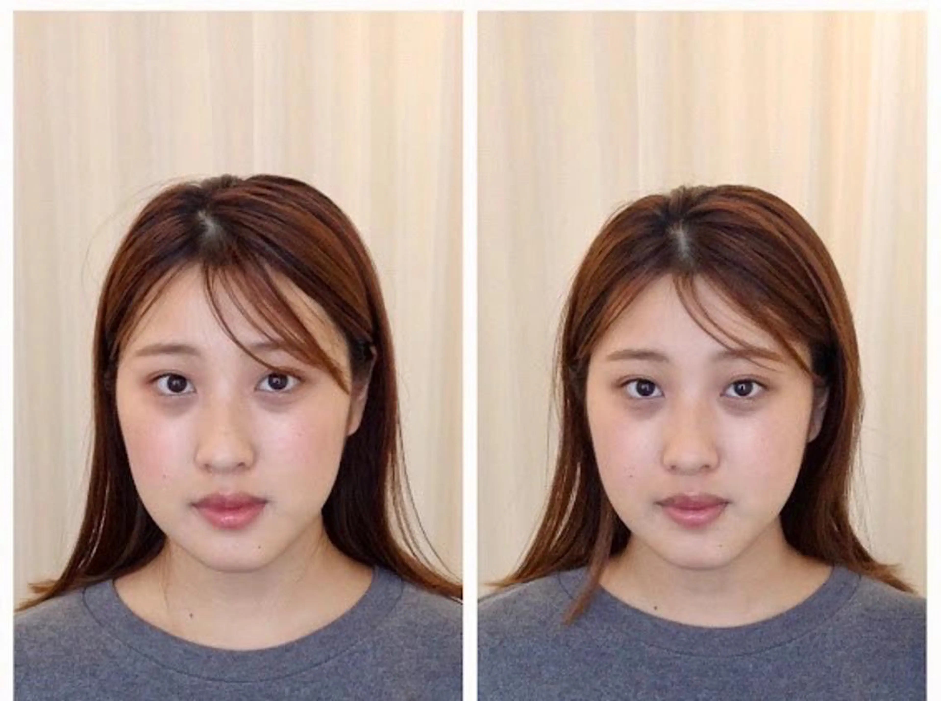 たるみ・しわ＋ストレートネック/姿勢改善の写真