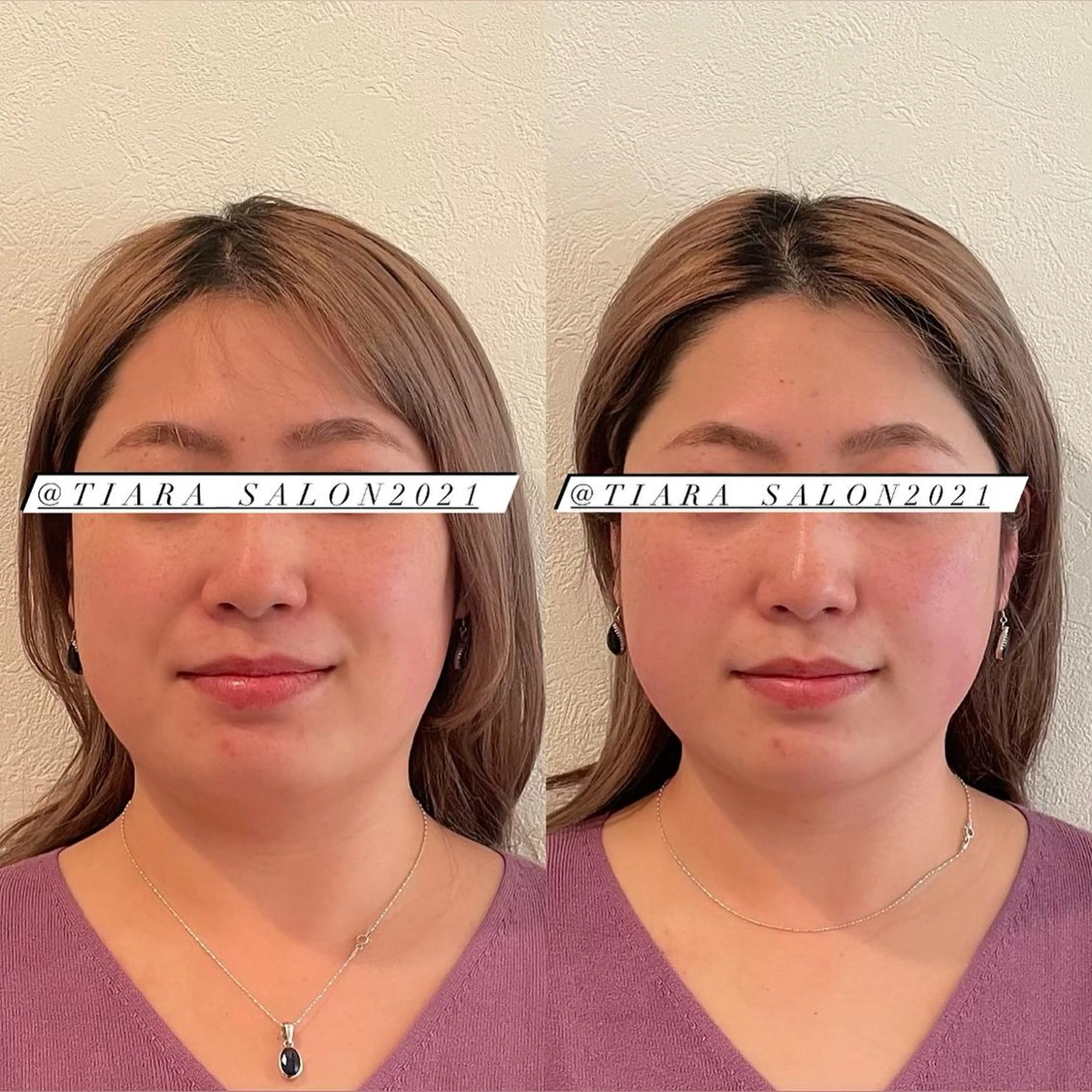 美容鍼灸サロン　TIARA所属・鍼灸サロン TIARA　美容鍼のエステ・リラクイメージ