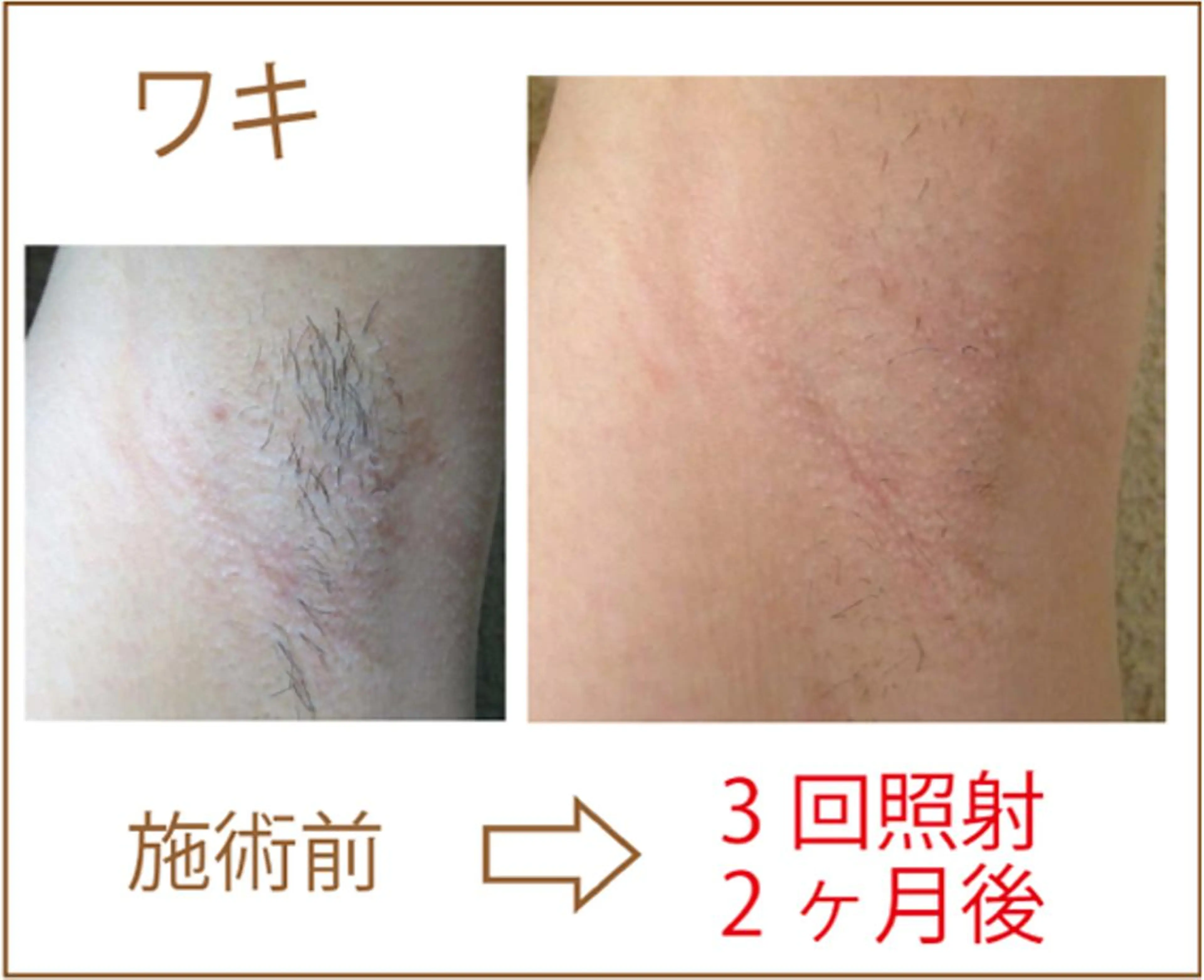 最後の脱毛に！脱毛カウンセリングをされた方に無料で１回！脇or手の甲の脱毛をプレゼントの写真