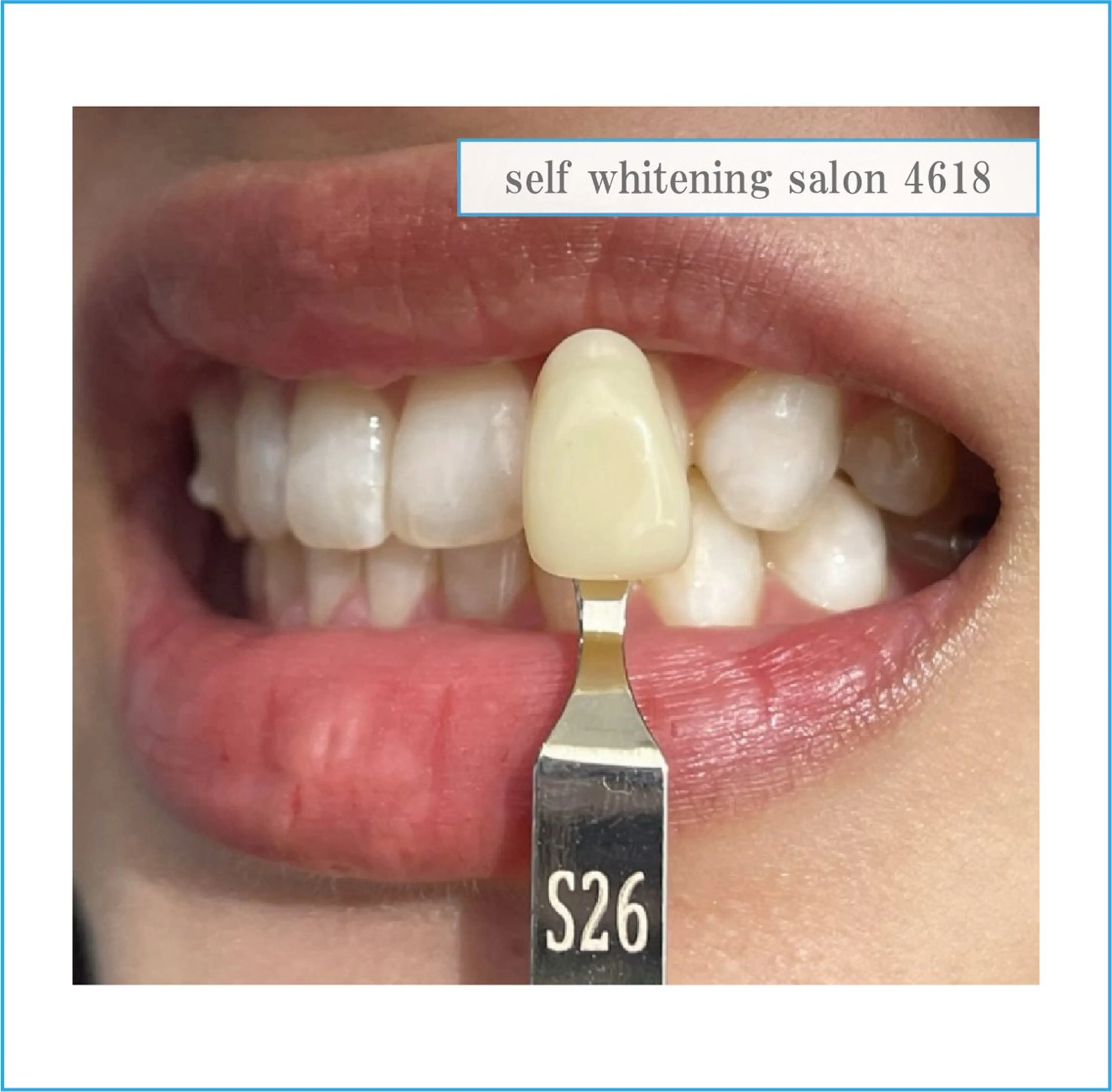 その他 self whitening salon 4618所属・ホワイトニングサロン 4618のその他イメージ