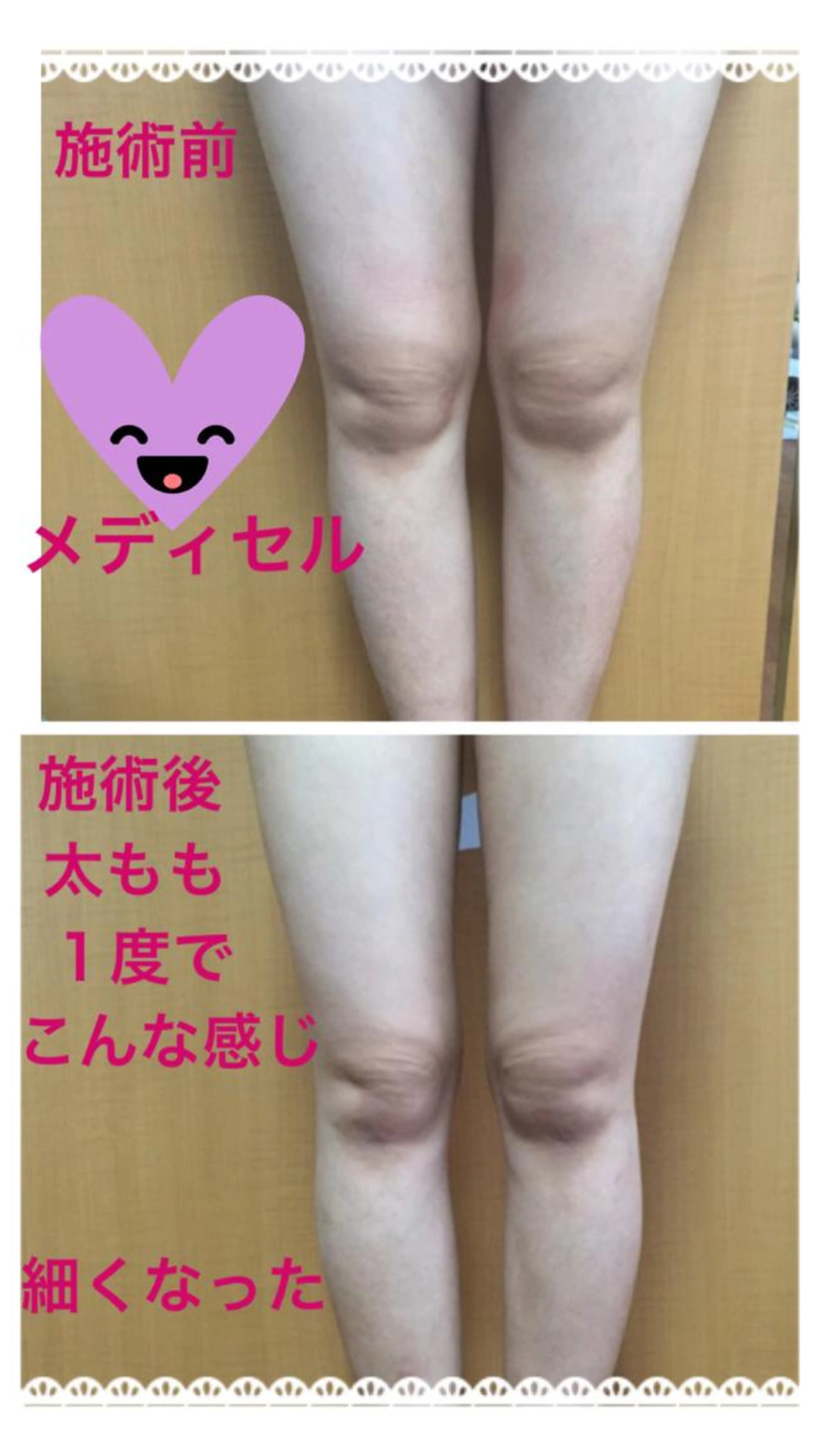 メディセル下半身!太もも、ふくらはぎ部分的に集中して引き締めたいの写真