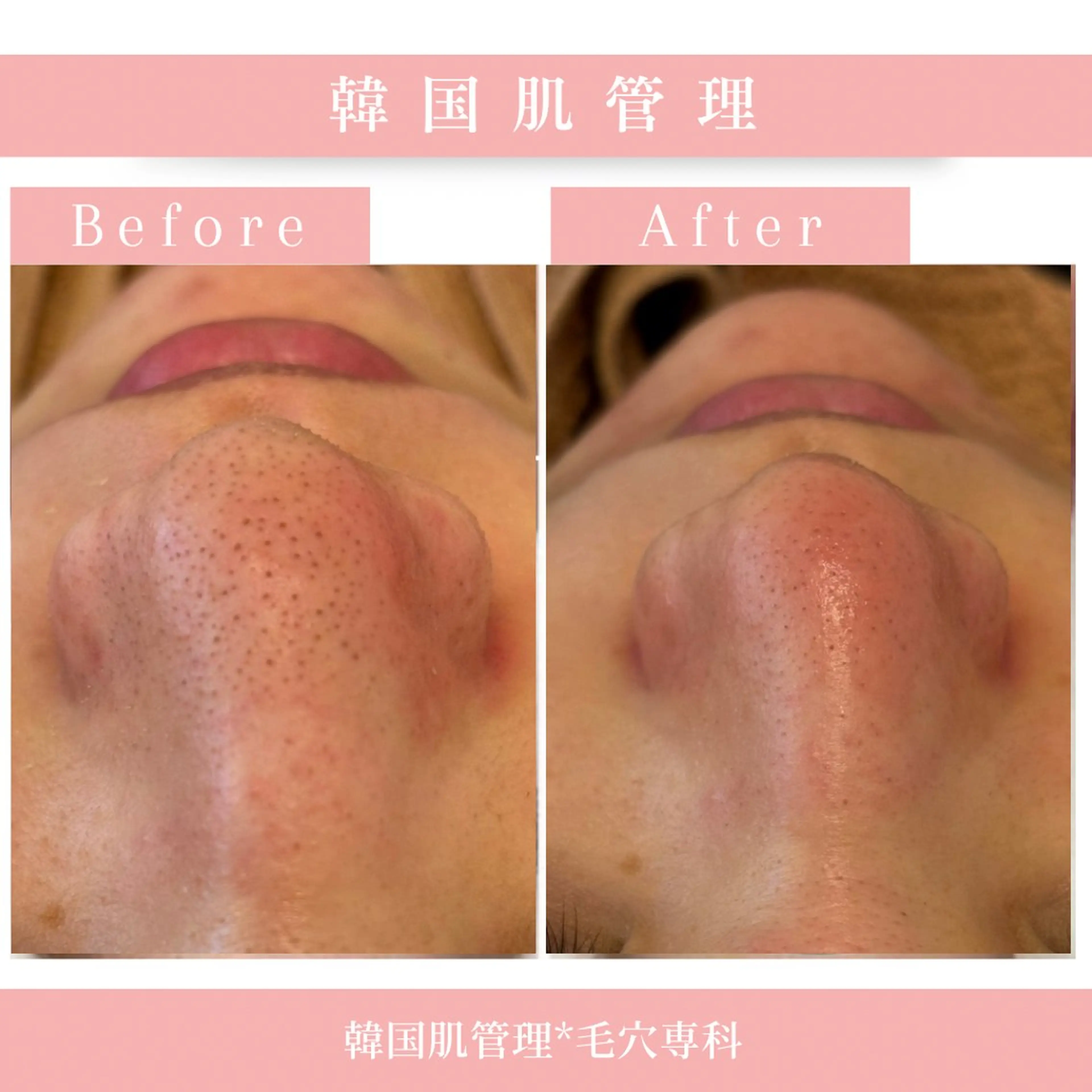 エステ リラク 韓国肌管理 【毛穴専科】のエステ・リラクイメージ