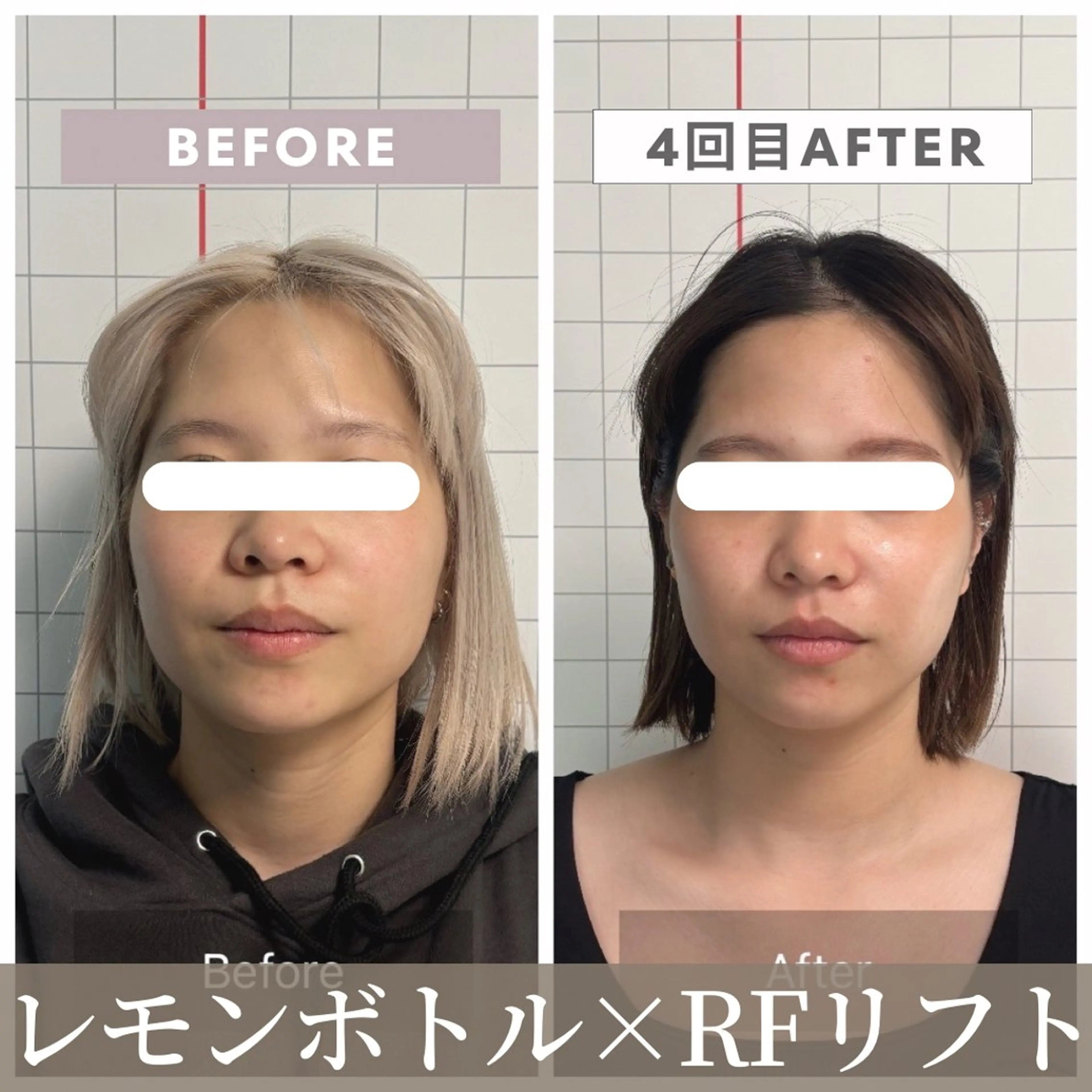 小顔矯正×デコルテリンパドレナージュ 60分 ¥4,980-【即日実感❣️小顔術】の写真