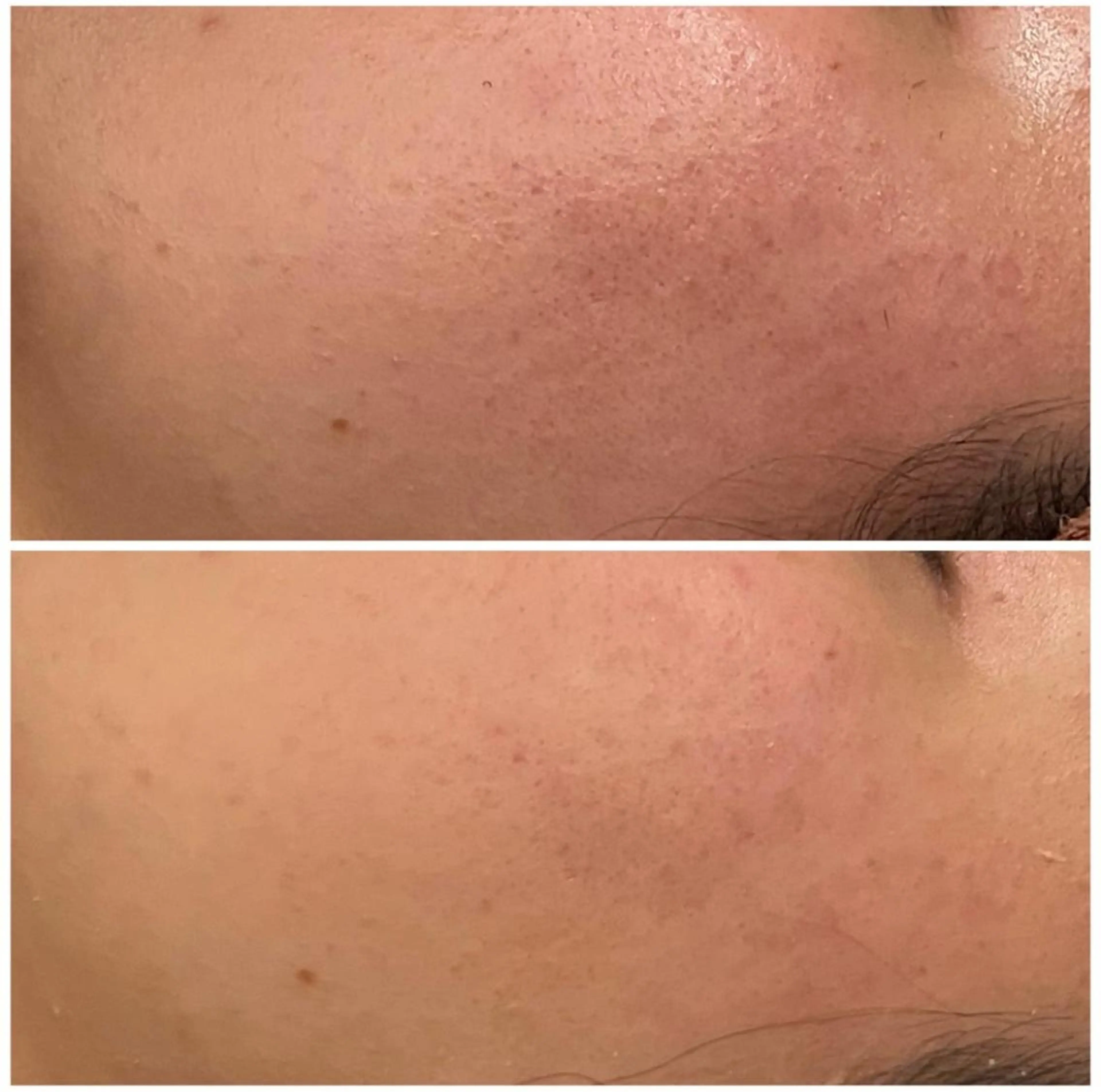 ニキビ跡改善専門🔥 医療にはできない改善のエステ・リラクイメージ