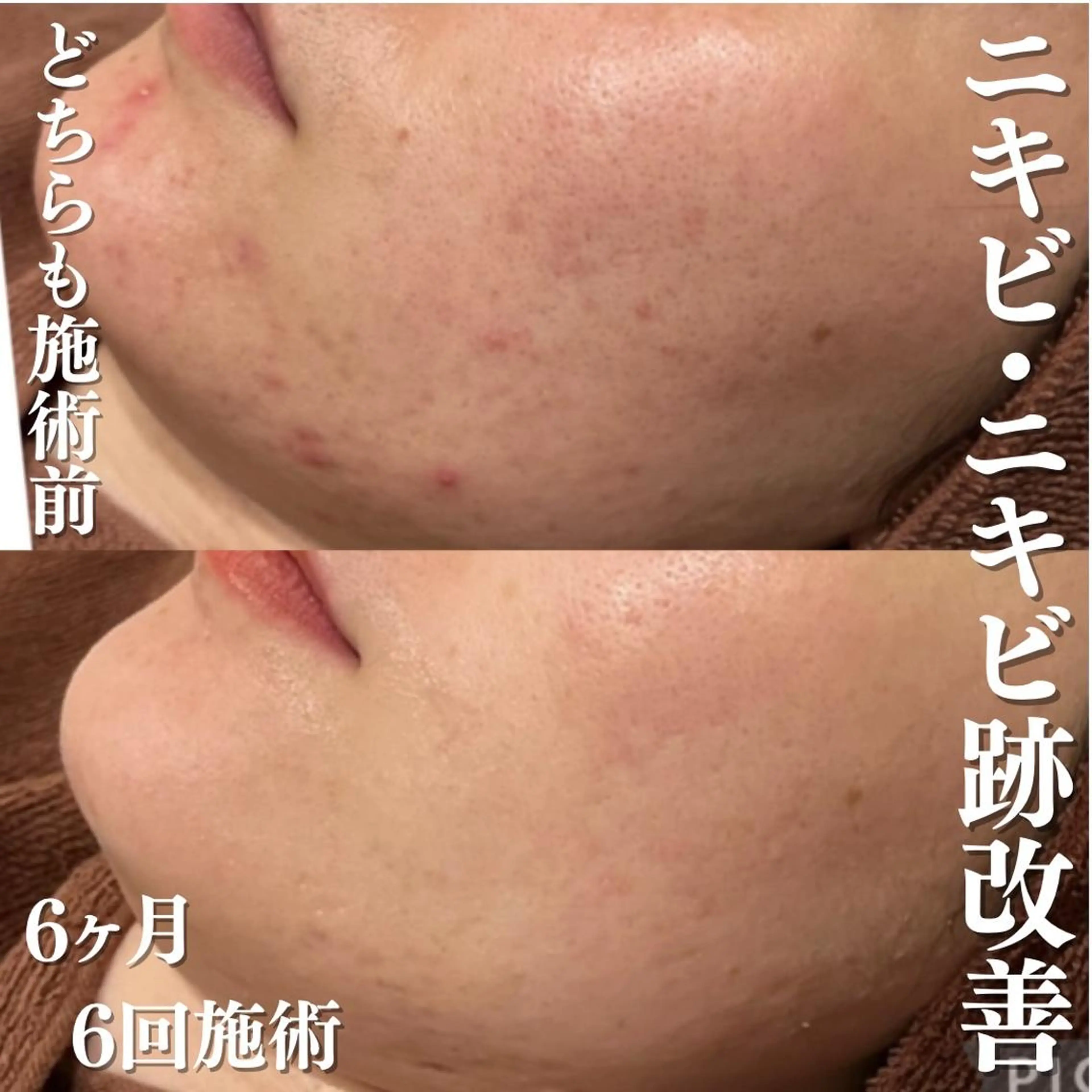 学生ニキビ改善🍀 優しい肌質改善のエステ・リラクイメージ