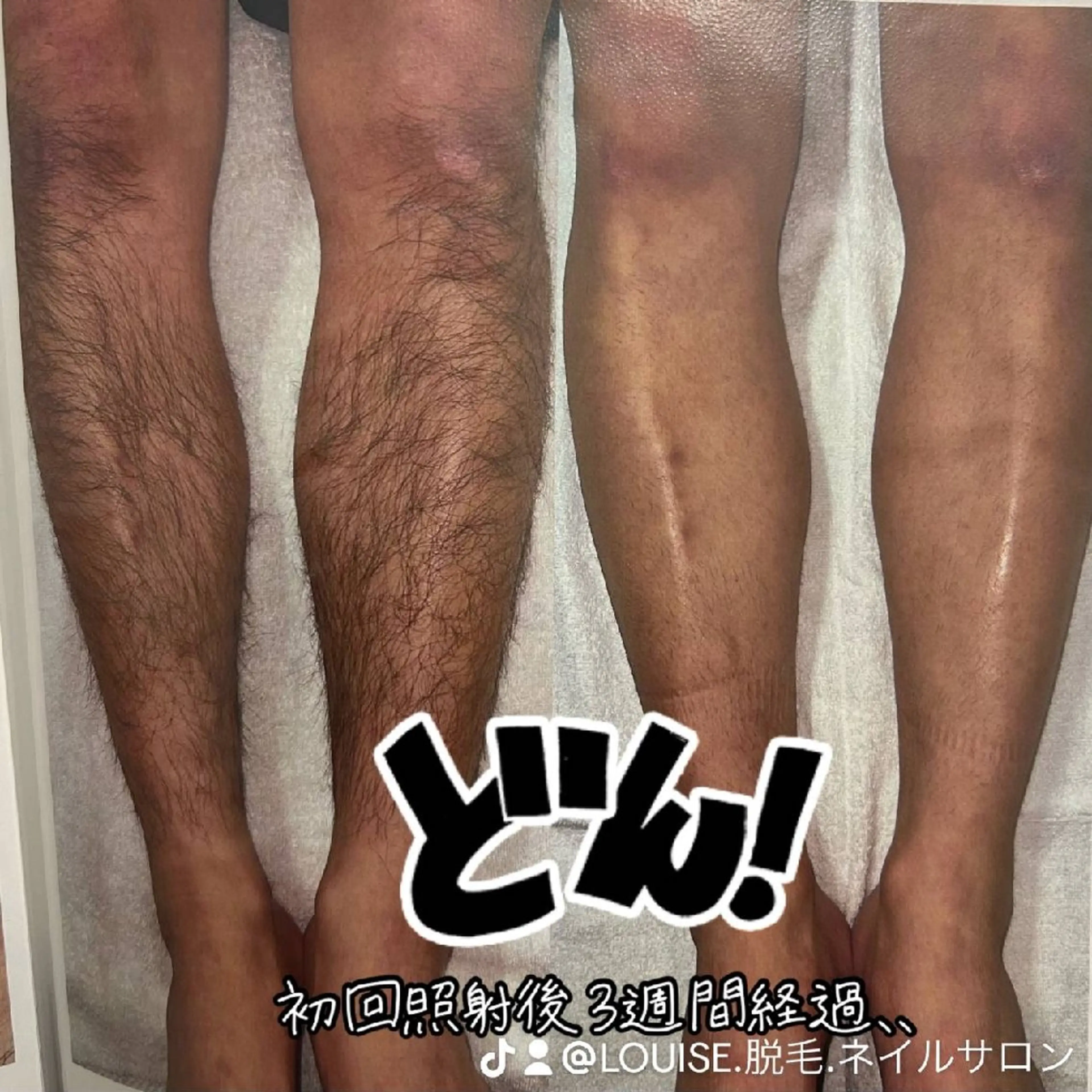 LOUISE.／脱毛所属・LOUISE. ／脱毛のエステ・リラクイメージ