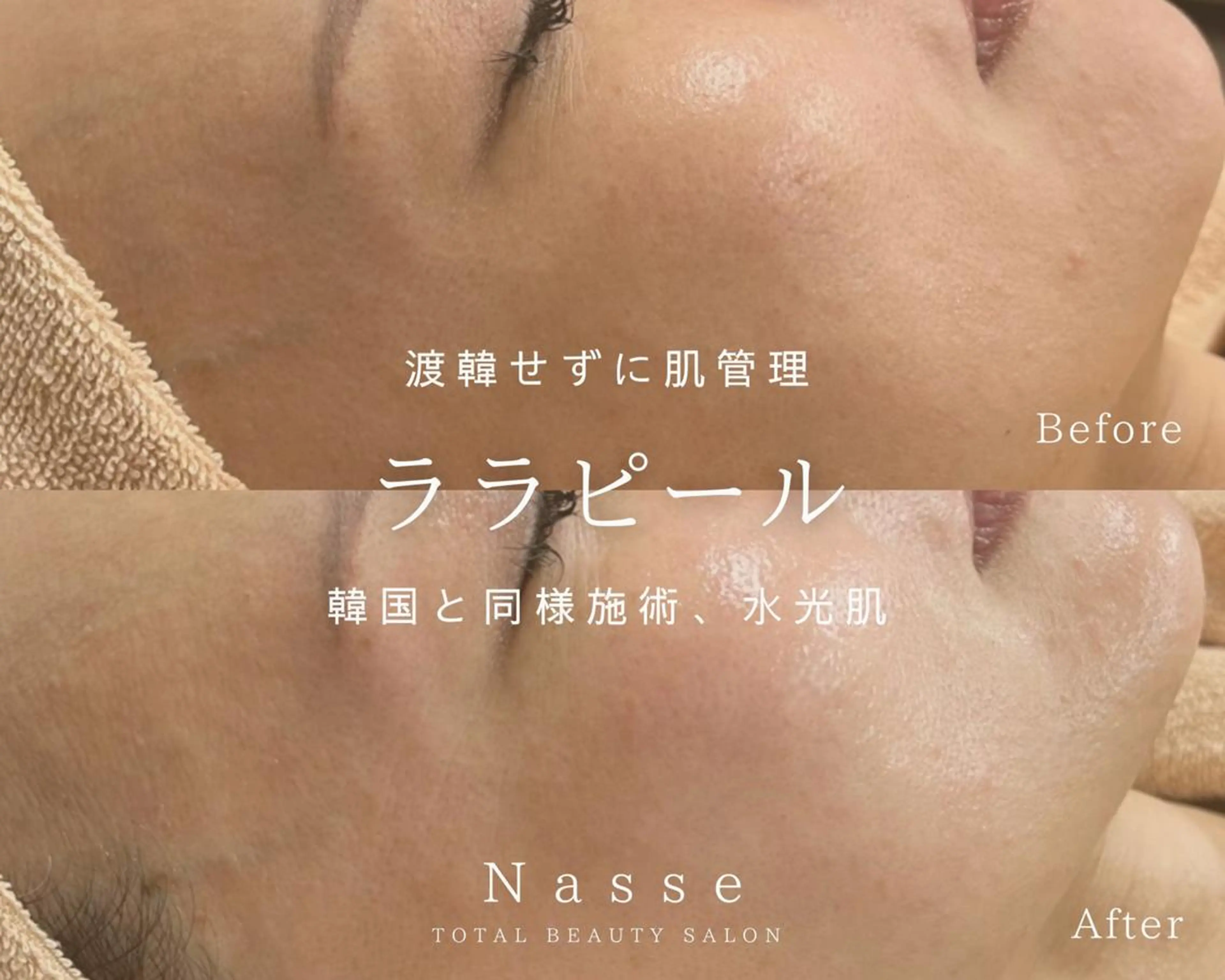 【韓国肌管理/毛穴/艶肌】ララ ピール（首込み）￥9800の写真