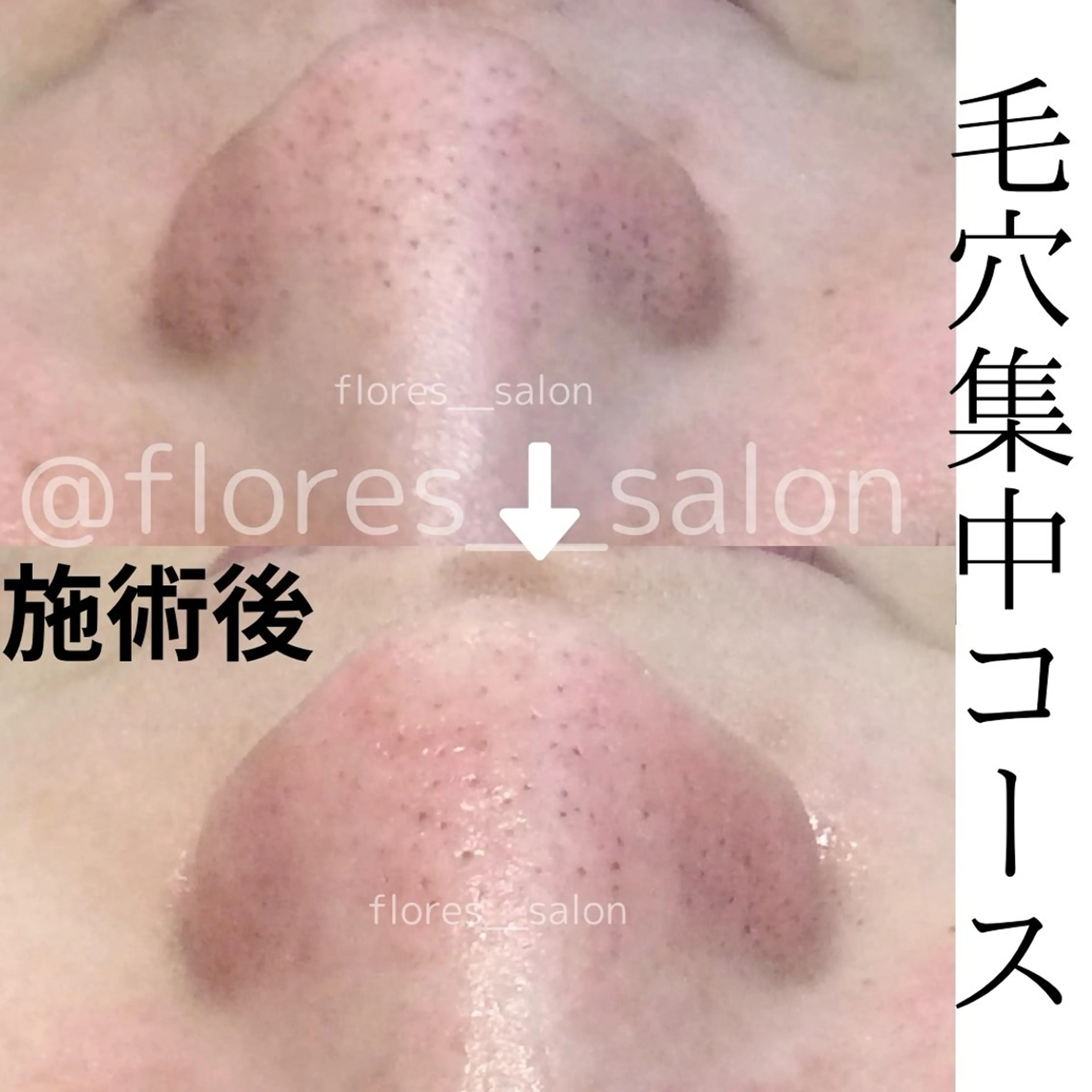 【通常】黒ずみ・ざらつきOFF！肌が変わる毛穴集中フェイシャル60分🫧 毛穴汚れ・ざらつき・黒ずみが気になる方に》の写真