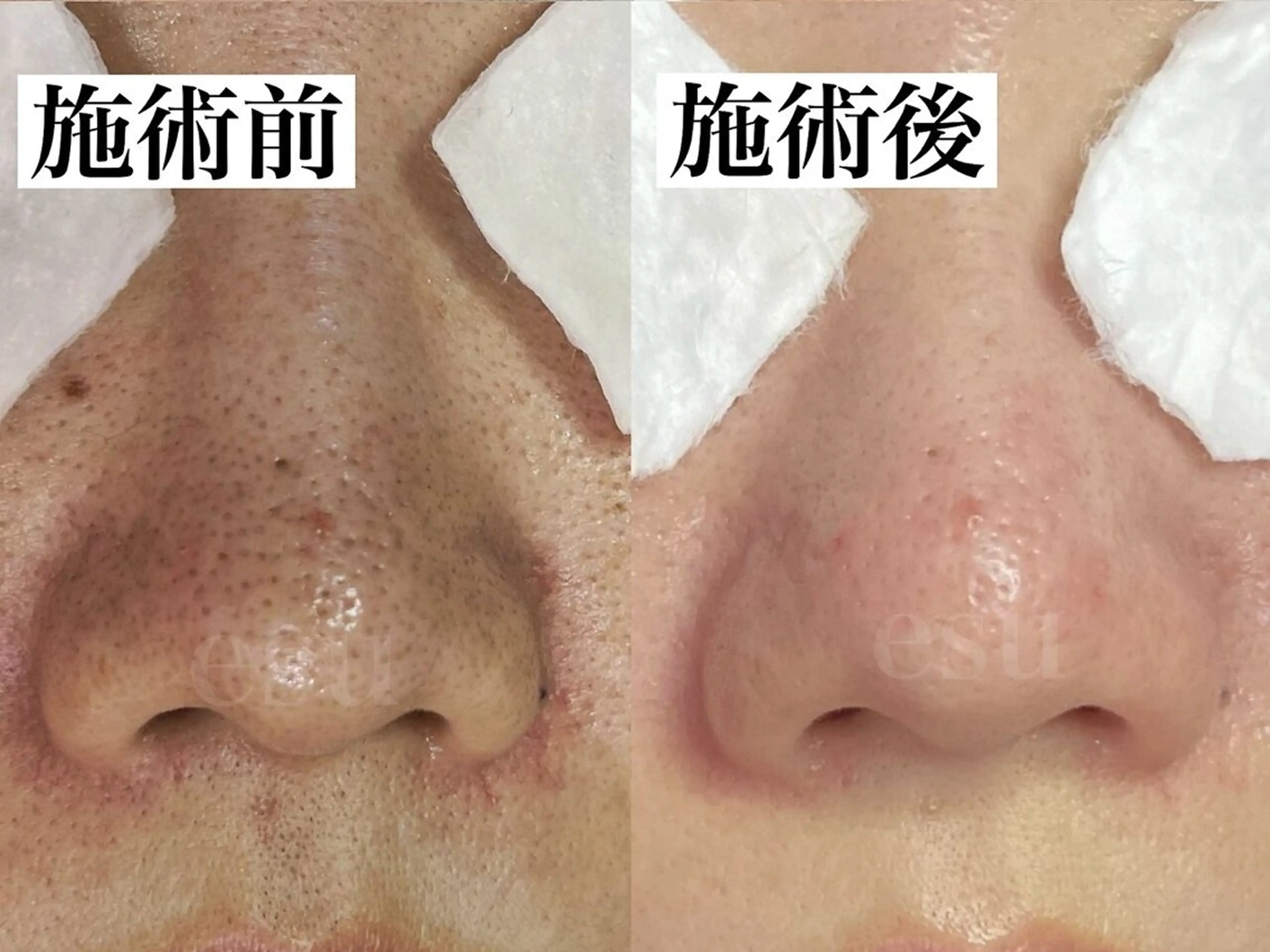 毛穴ケア専門店 esu(エス)のエステ・リラクイメージ