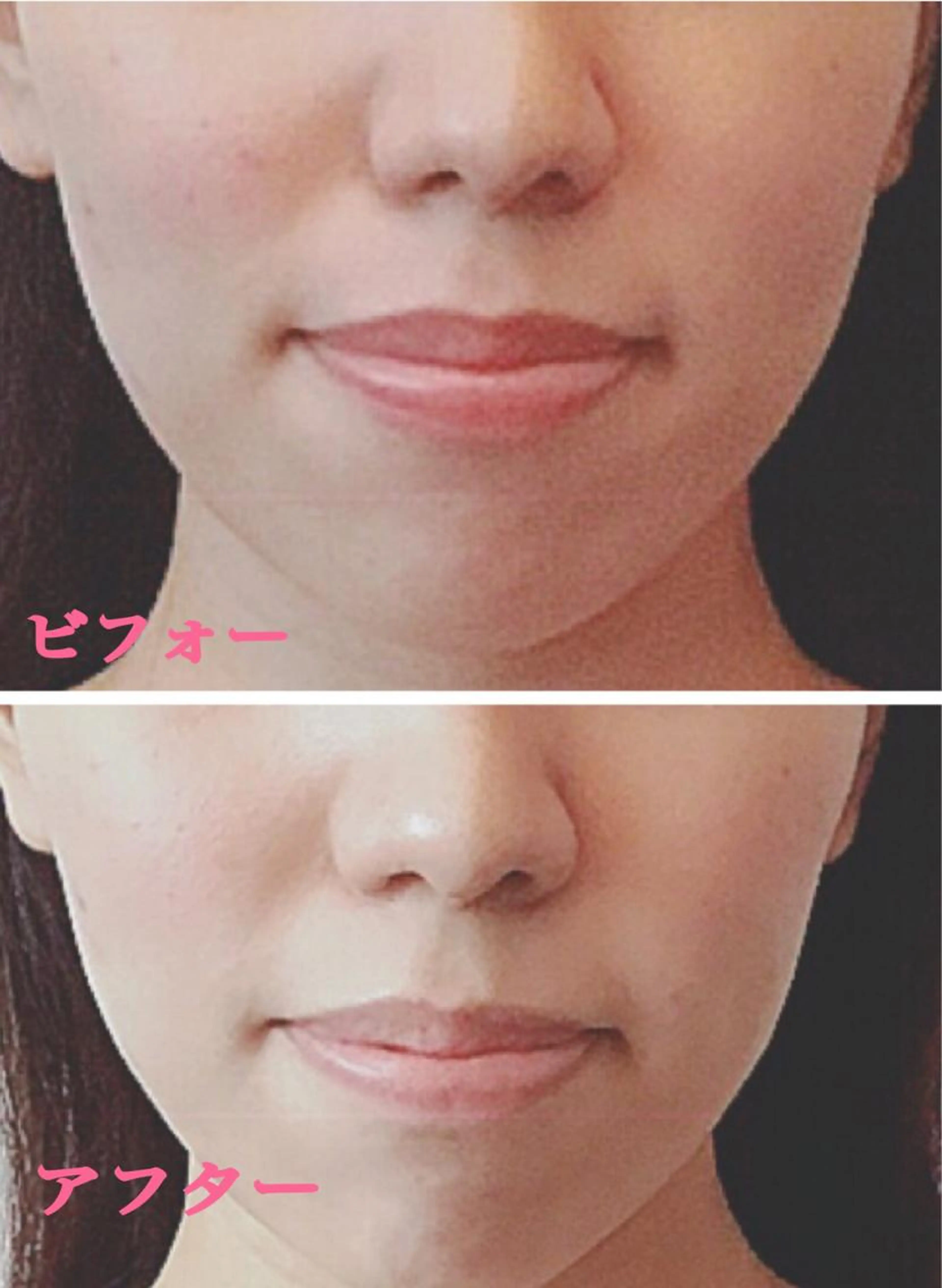 (モニター小顔美容矯正+石膏パック)の写真