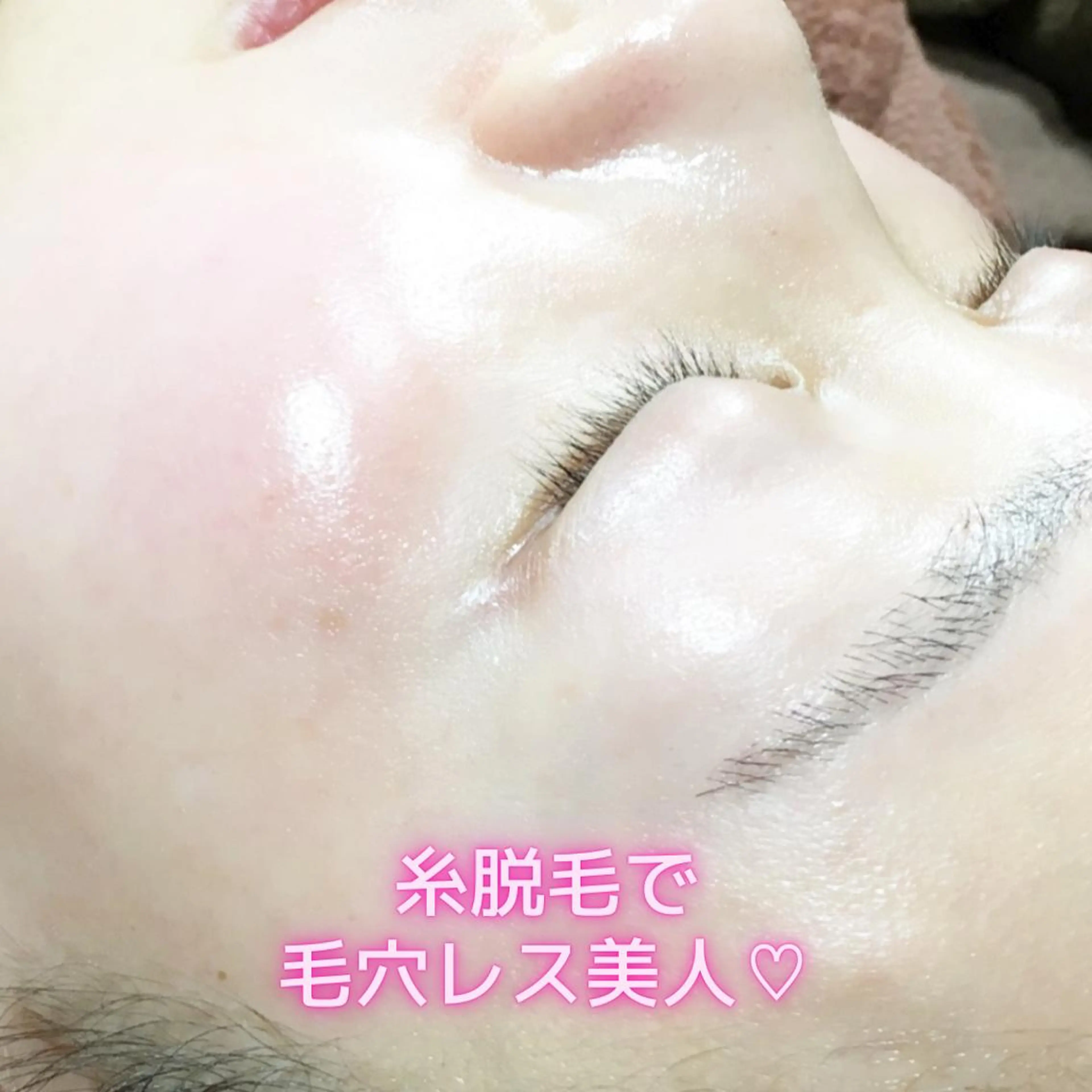 お顔全体の糸エステ体験(額・眉毛デザイン・鼻・両頬・お口周り・フェイスライン顎)🧵+シートパック付き✨の写真