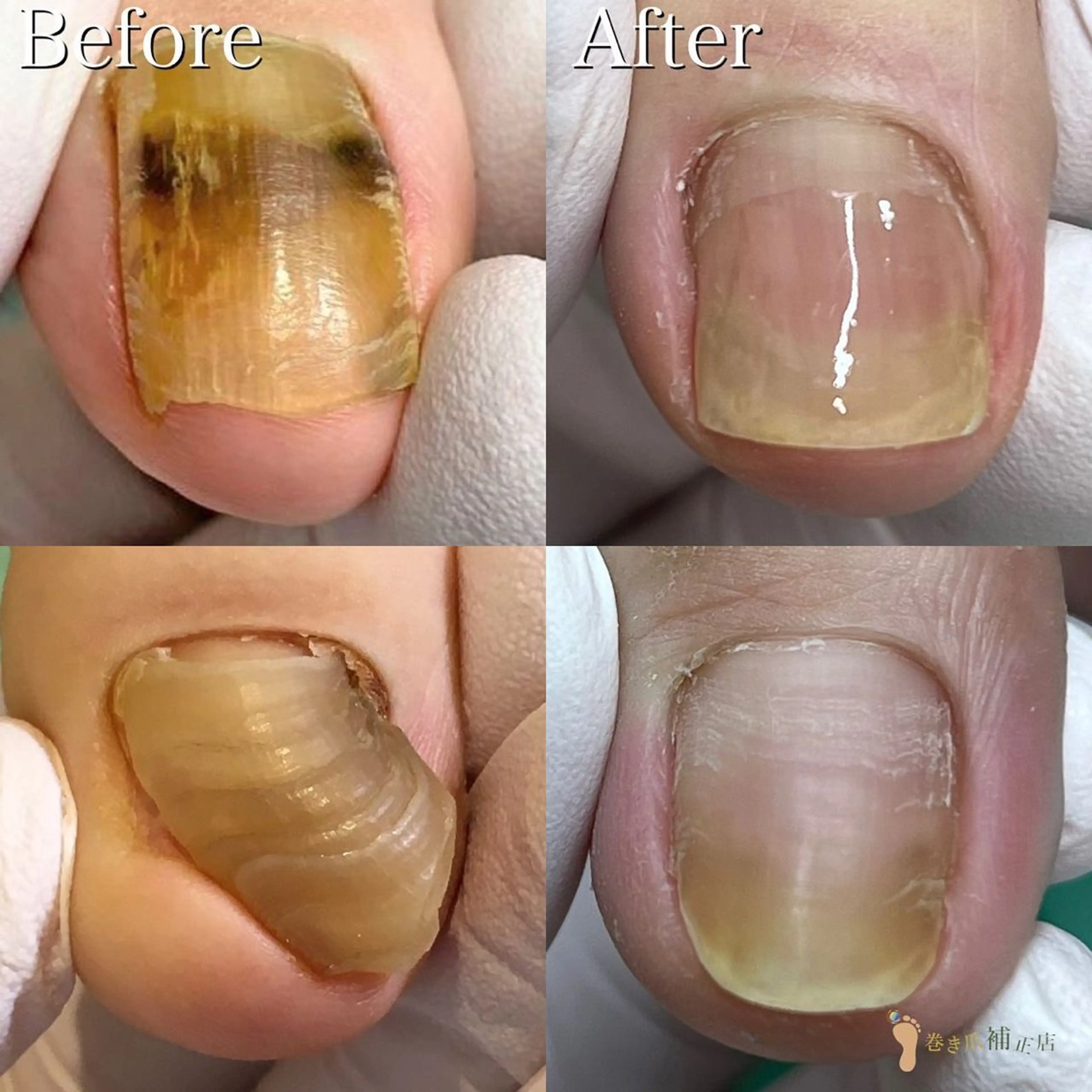 【足の分厚い爪・深爪再生補正】2爪✨思わず隠したくなるその爪🥹あきらめないでください🦶🏻正常な爪へと再生致します✨の写真