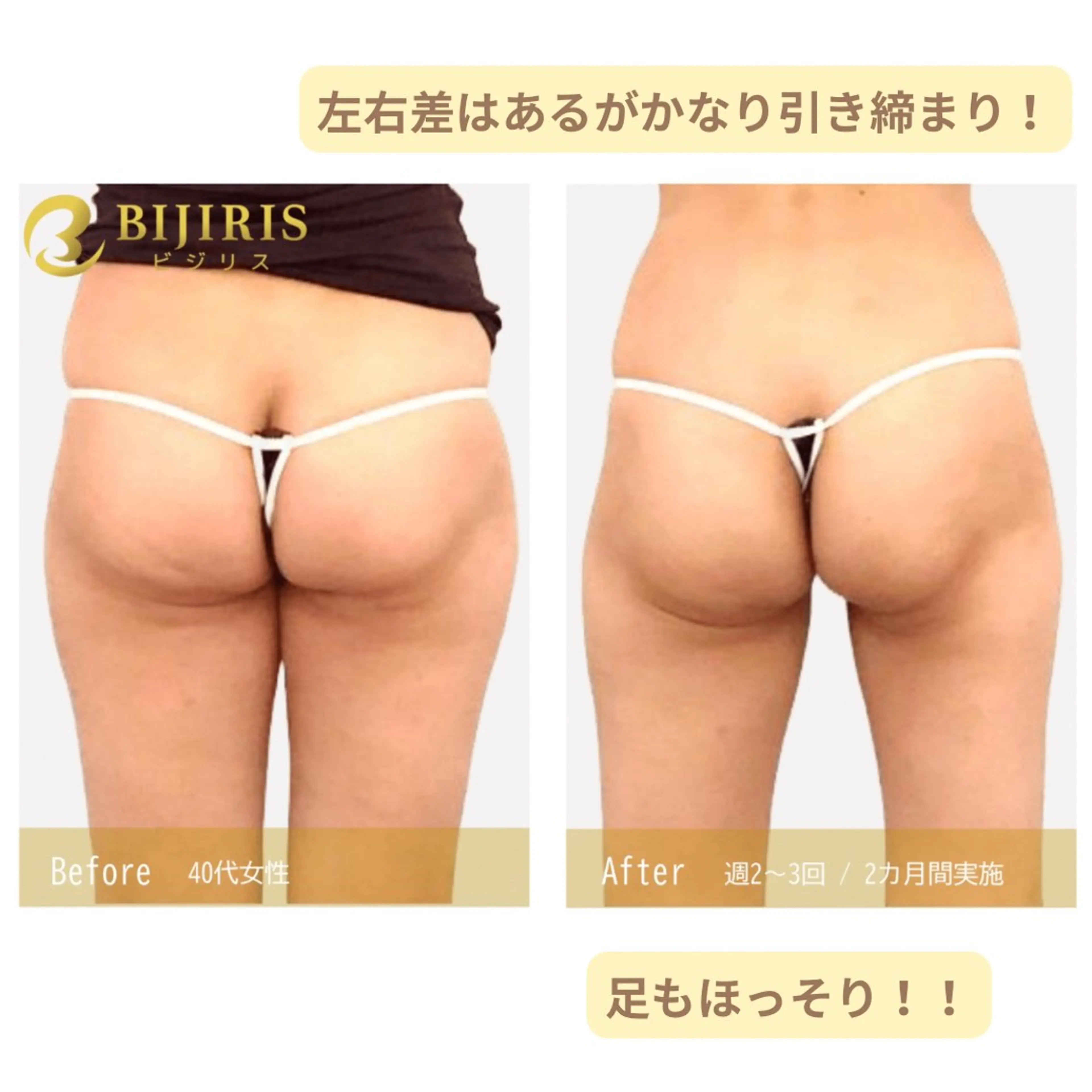 セルフ脱毛/美尻イス キングスサロン熊本のエステ・リラクイメージ