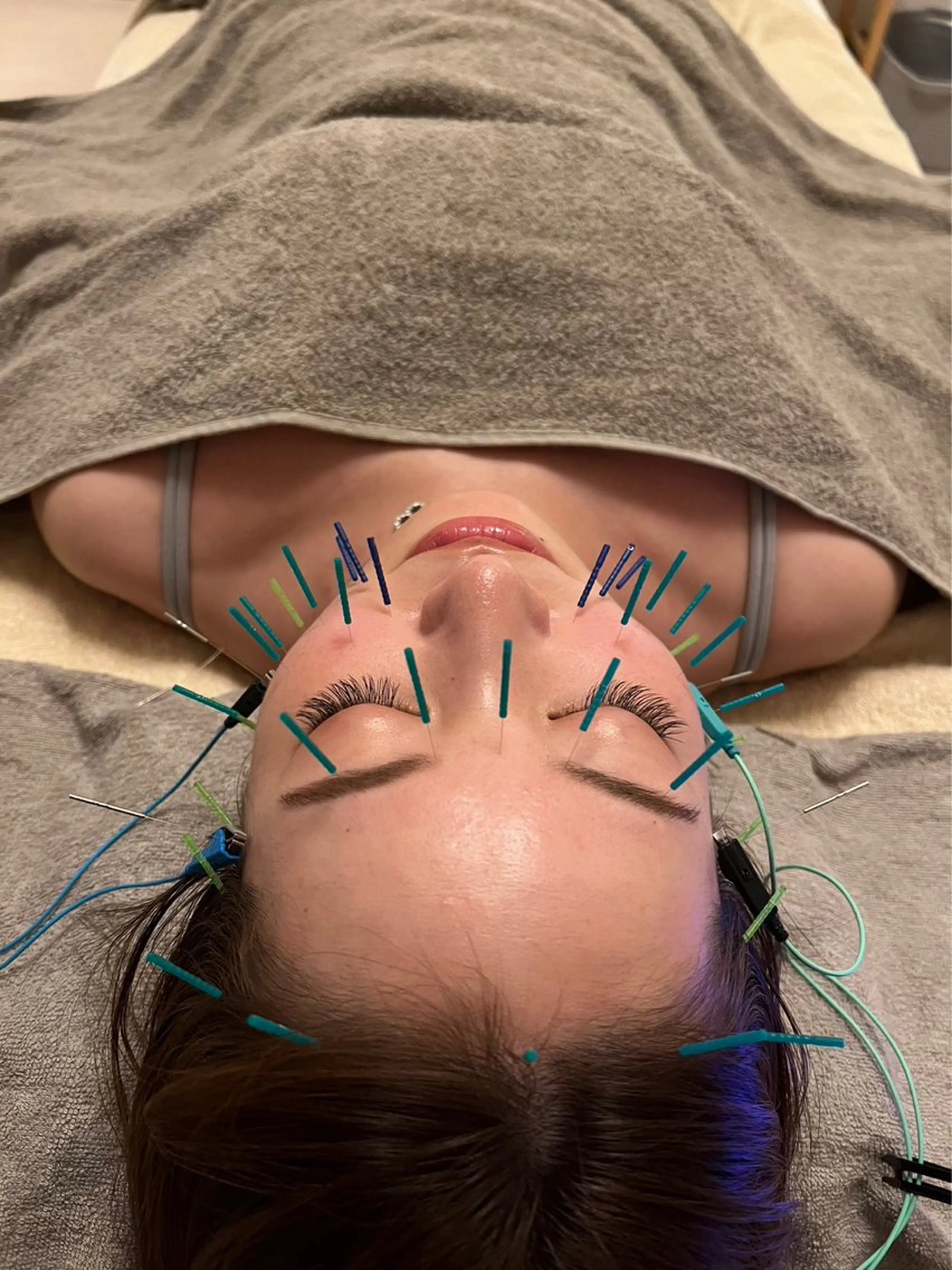 鍼灸•マッサージサロンCalfa所属・《美肌･小顔》美容鍼 ＆マッサージ＊MEIのエステ・リラクイメージ