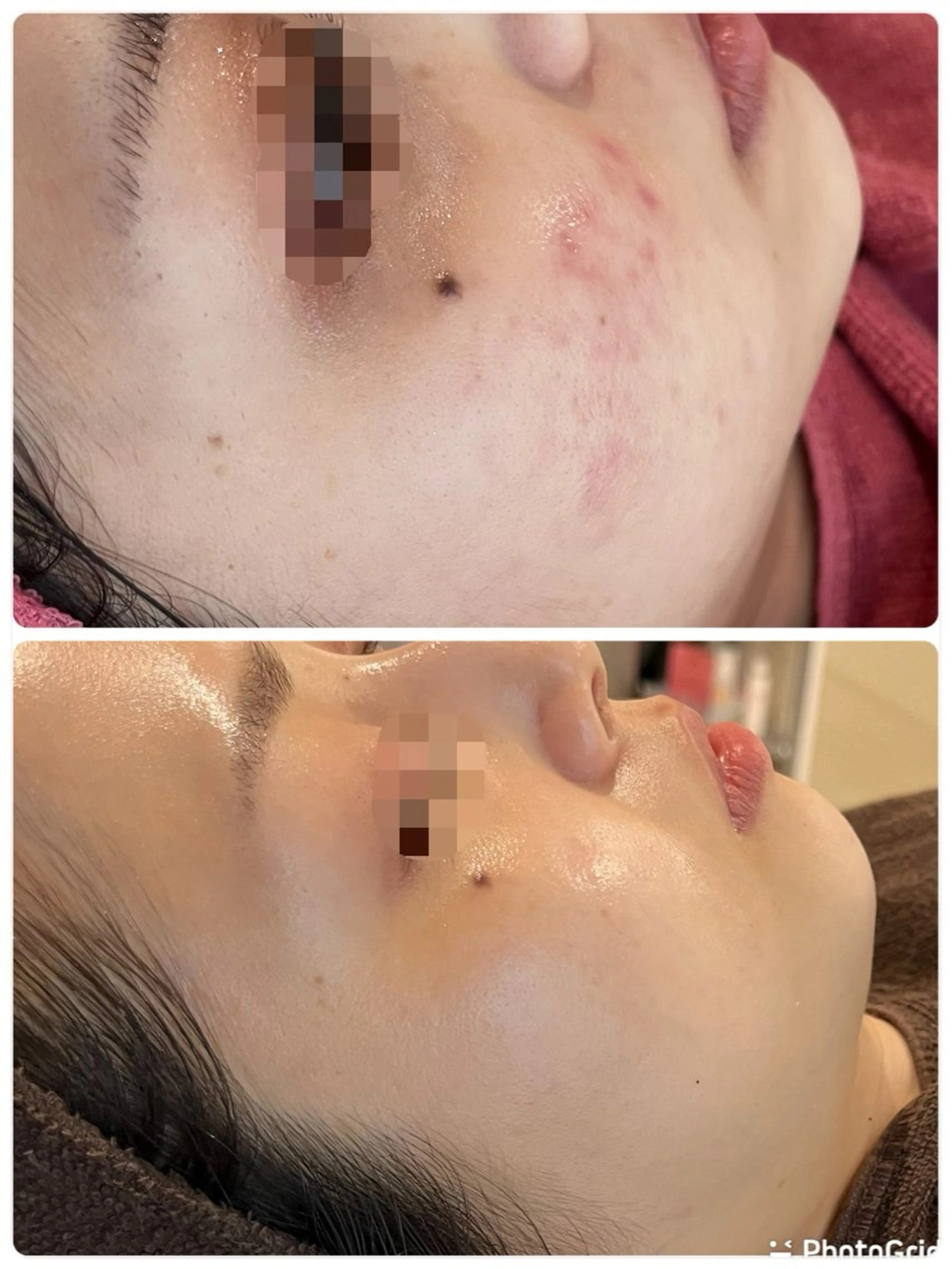 エステ 【リベルハーブピーリング認定店】敏感肌・美白脱毛専門店Dione立川店所属・Dione 立川店のエステ・リラクイメージ