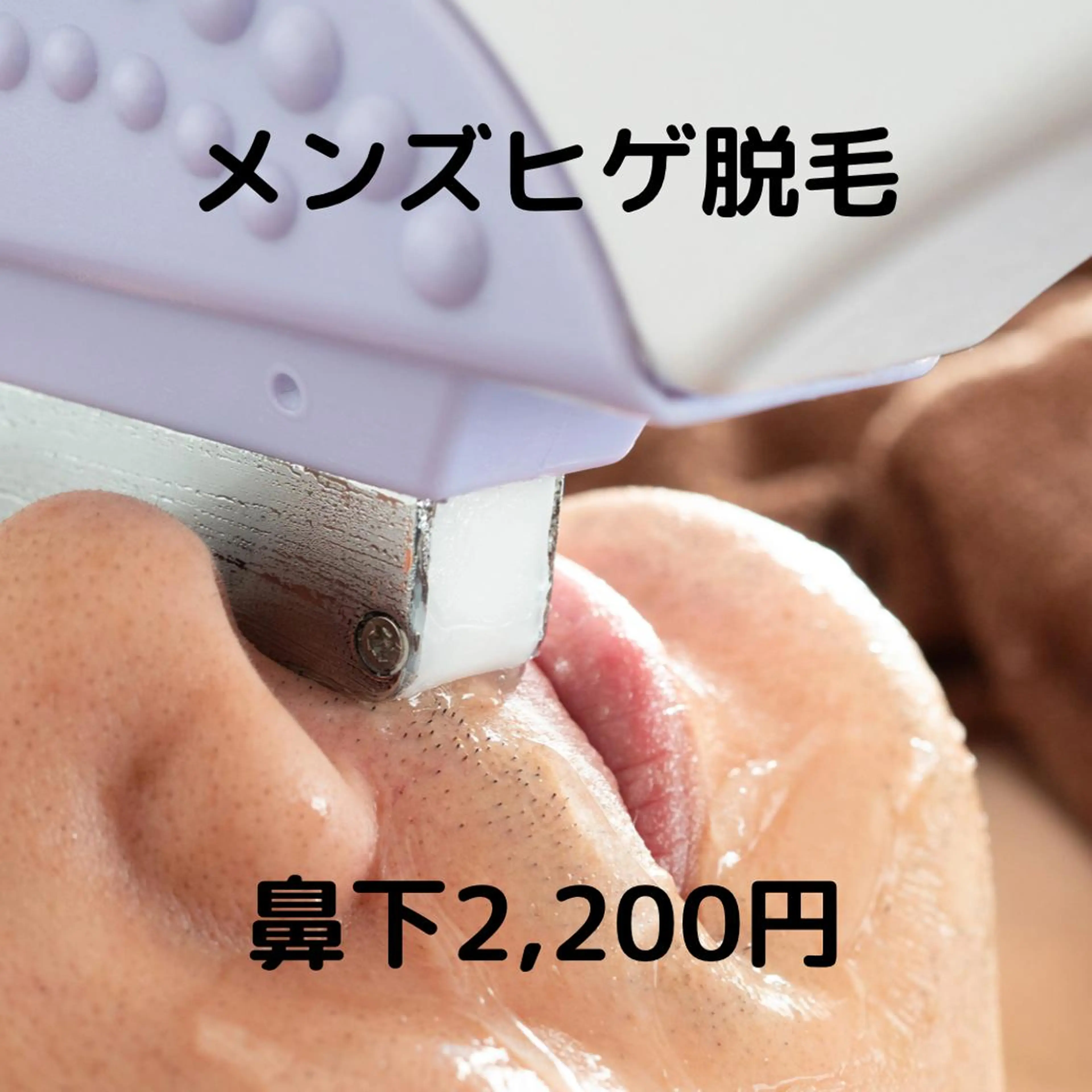 男性【快適♪ヒゲ鼻下脱毛】◎都度払い　SSパーツ/　鼻下回数：1回料金：¥2,200の写真