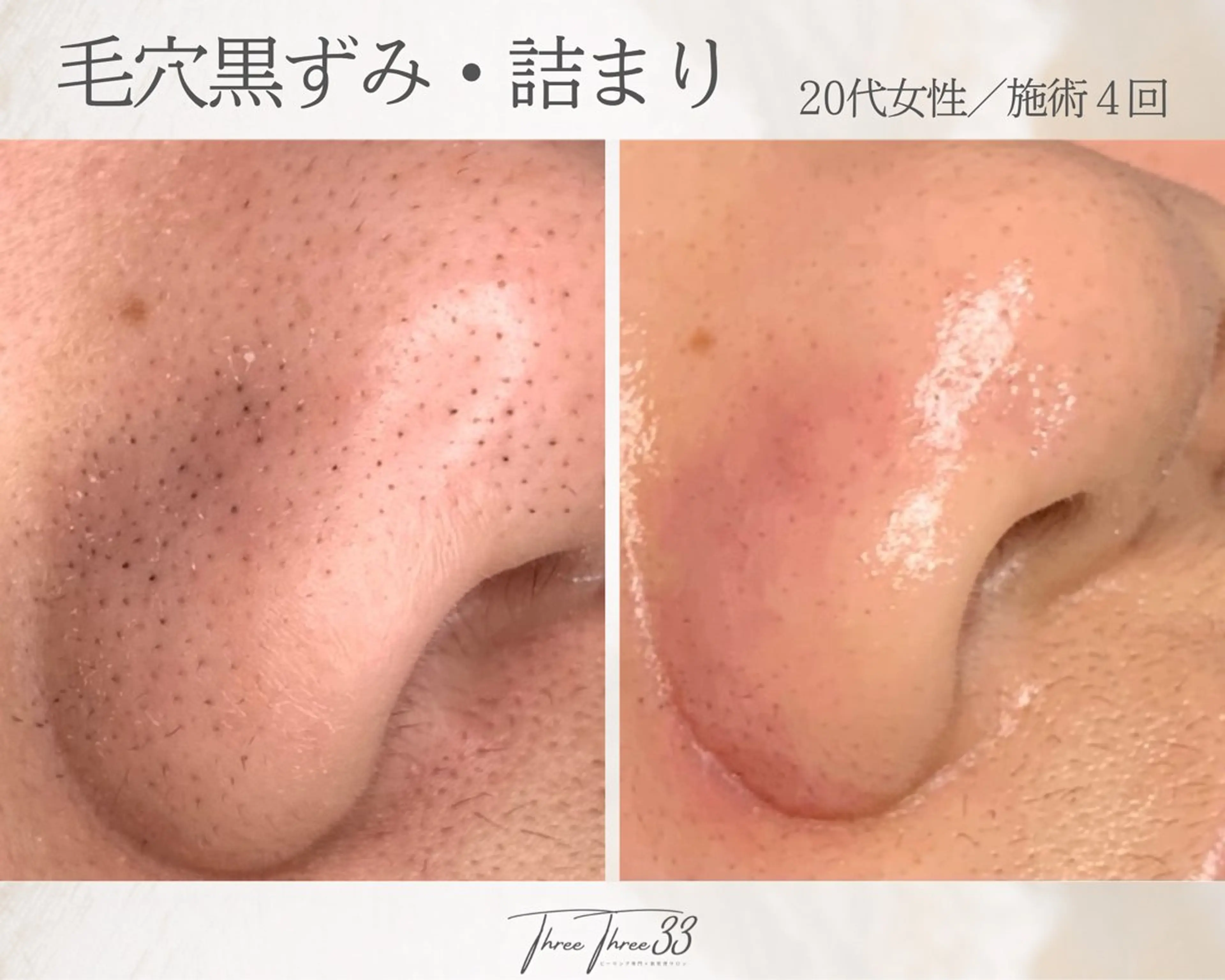 ピーリング×肌管理 THREETHREEのエステ・リラクイメージ