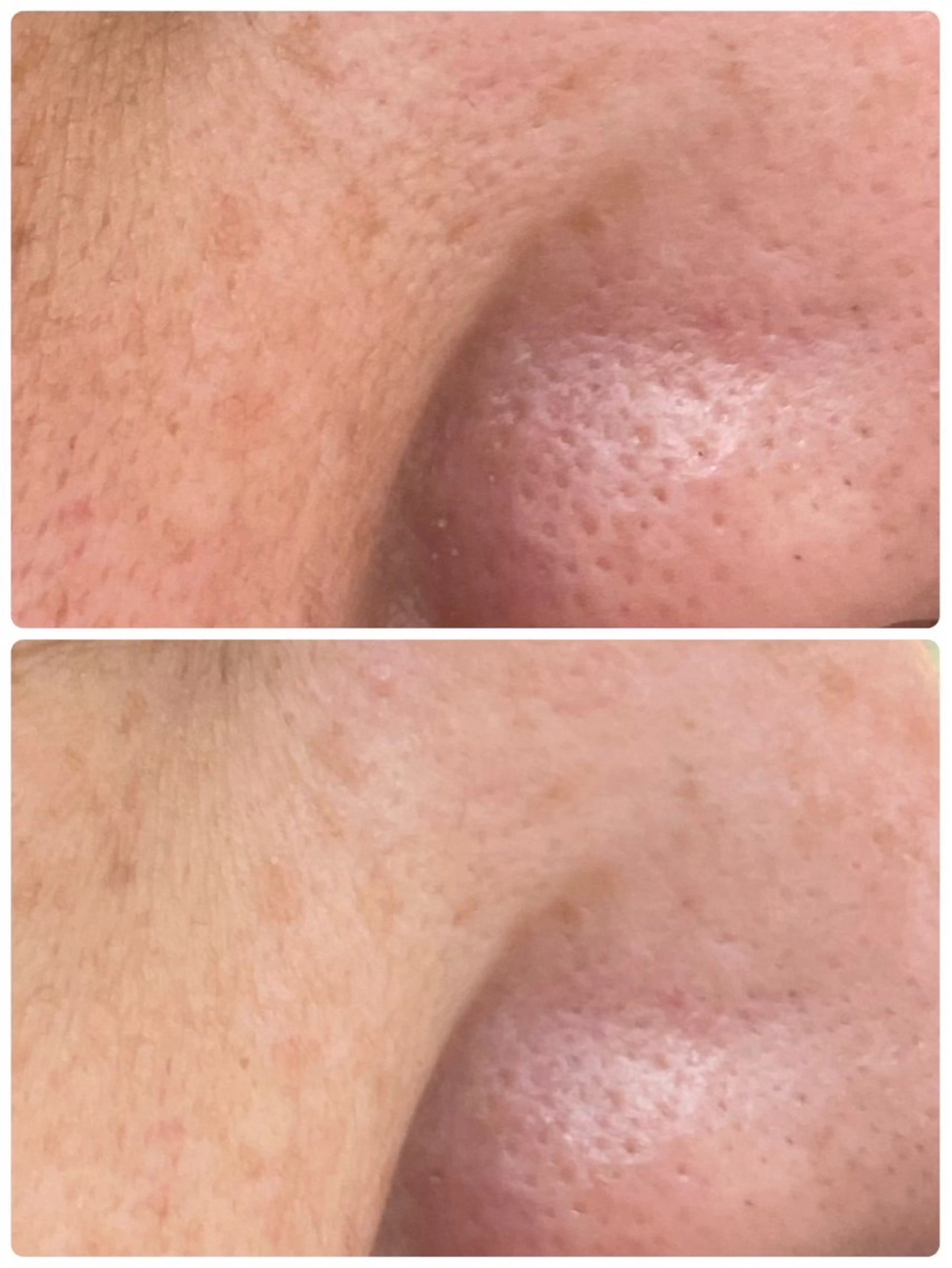 エステ NARIS BEAUTY STATION　デ・アイム あべのルシアス所属・ニキビ跡/毛穴/ 肌質改善/北村ももこのエステ・リラクイメージ