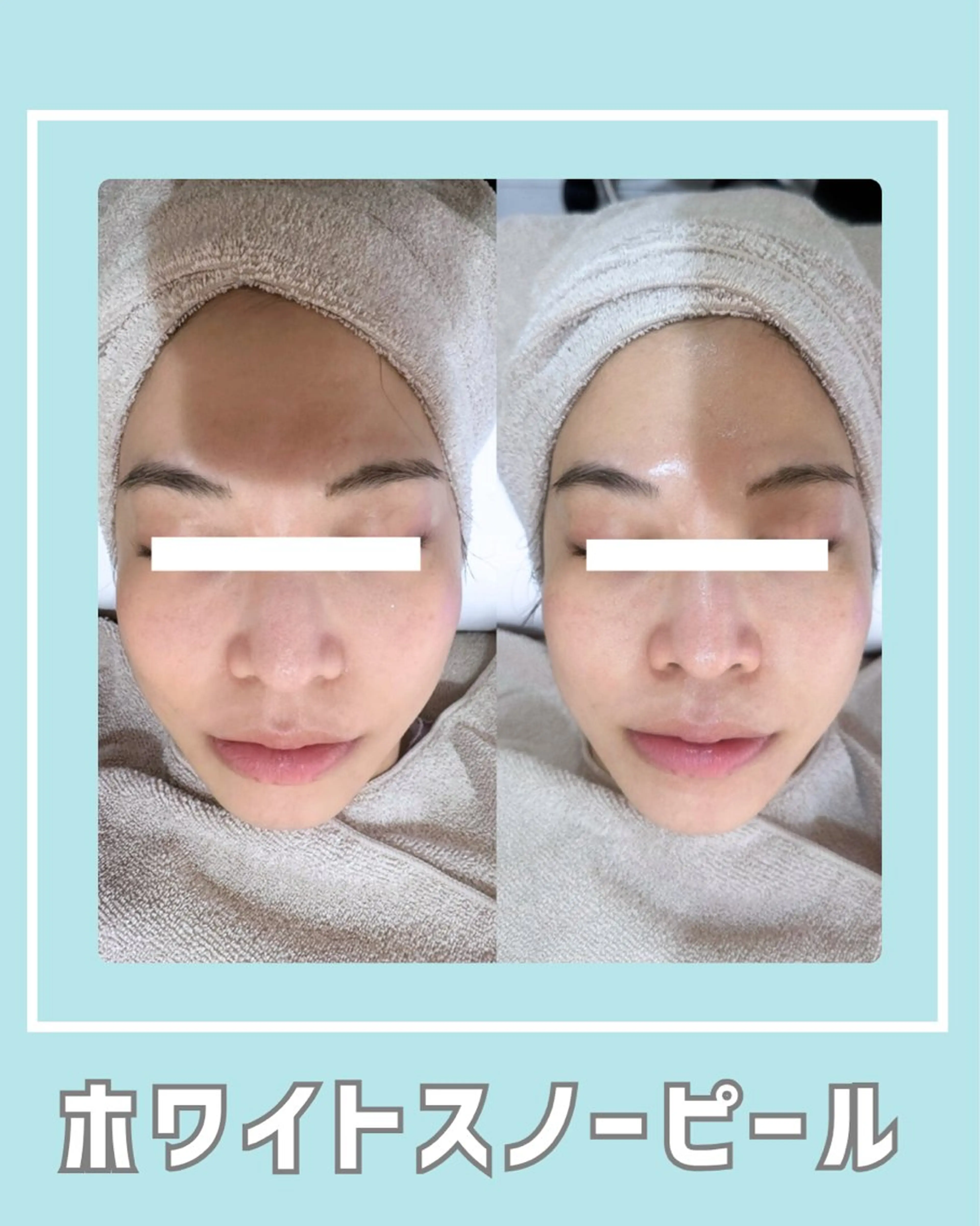 エステ |ピーリング・毛穴| soina神楽坂のエステ・リラクイメージ