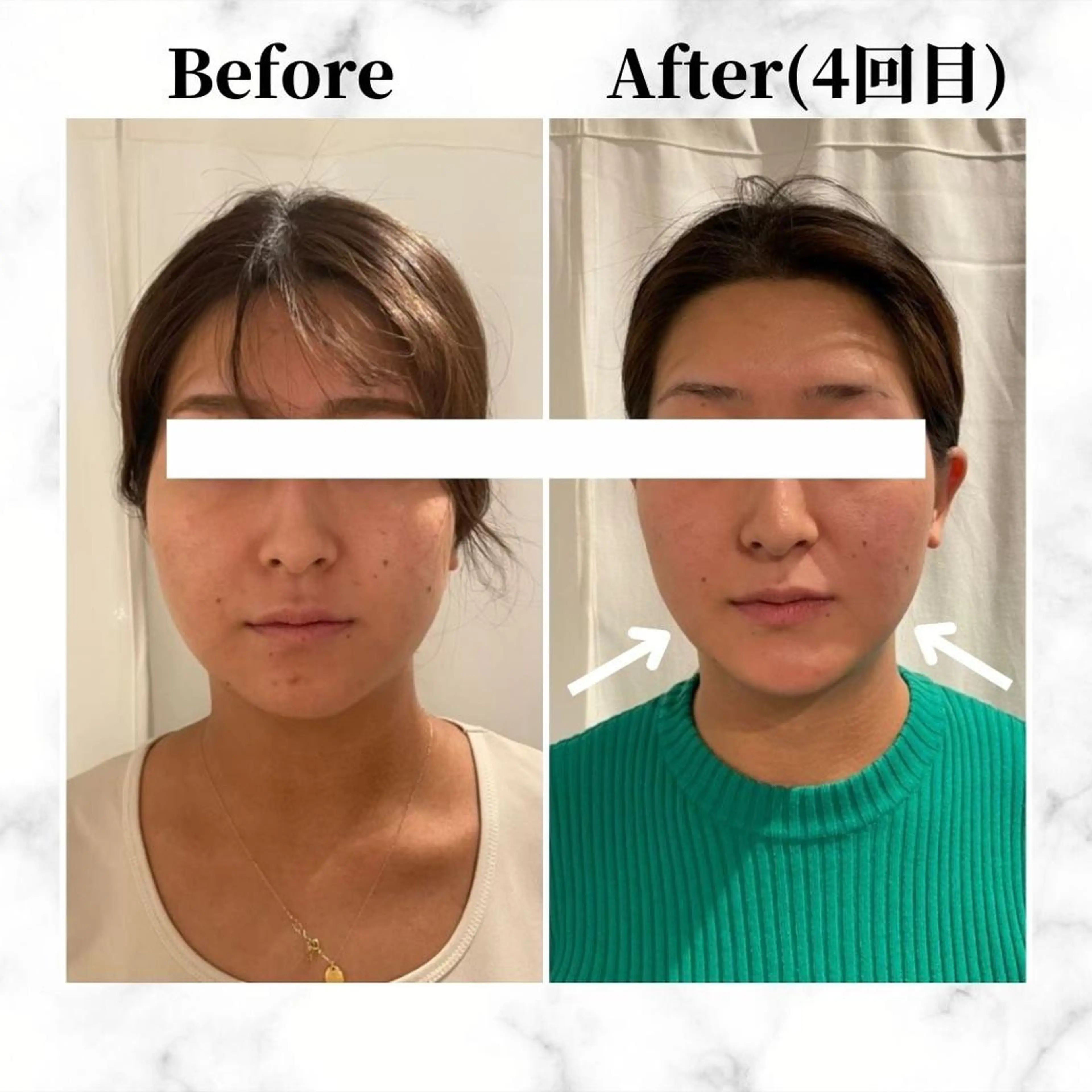 エステ リラク 12Dハイフ💗 最強小顔のエステ・リラクイメージ