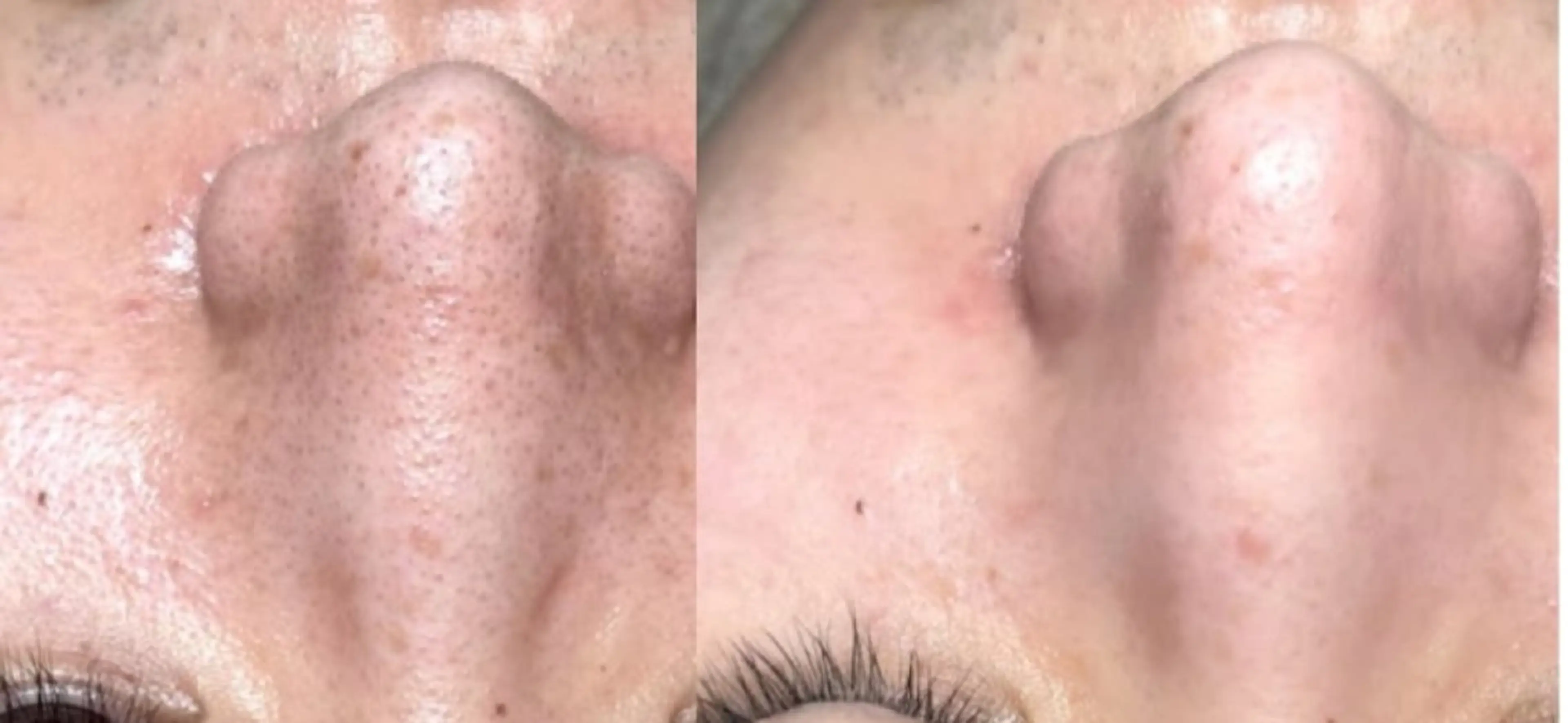 黒ずみ撃退、韓国式毛穴洗浄全顔プランの写真