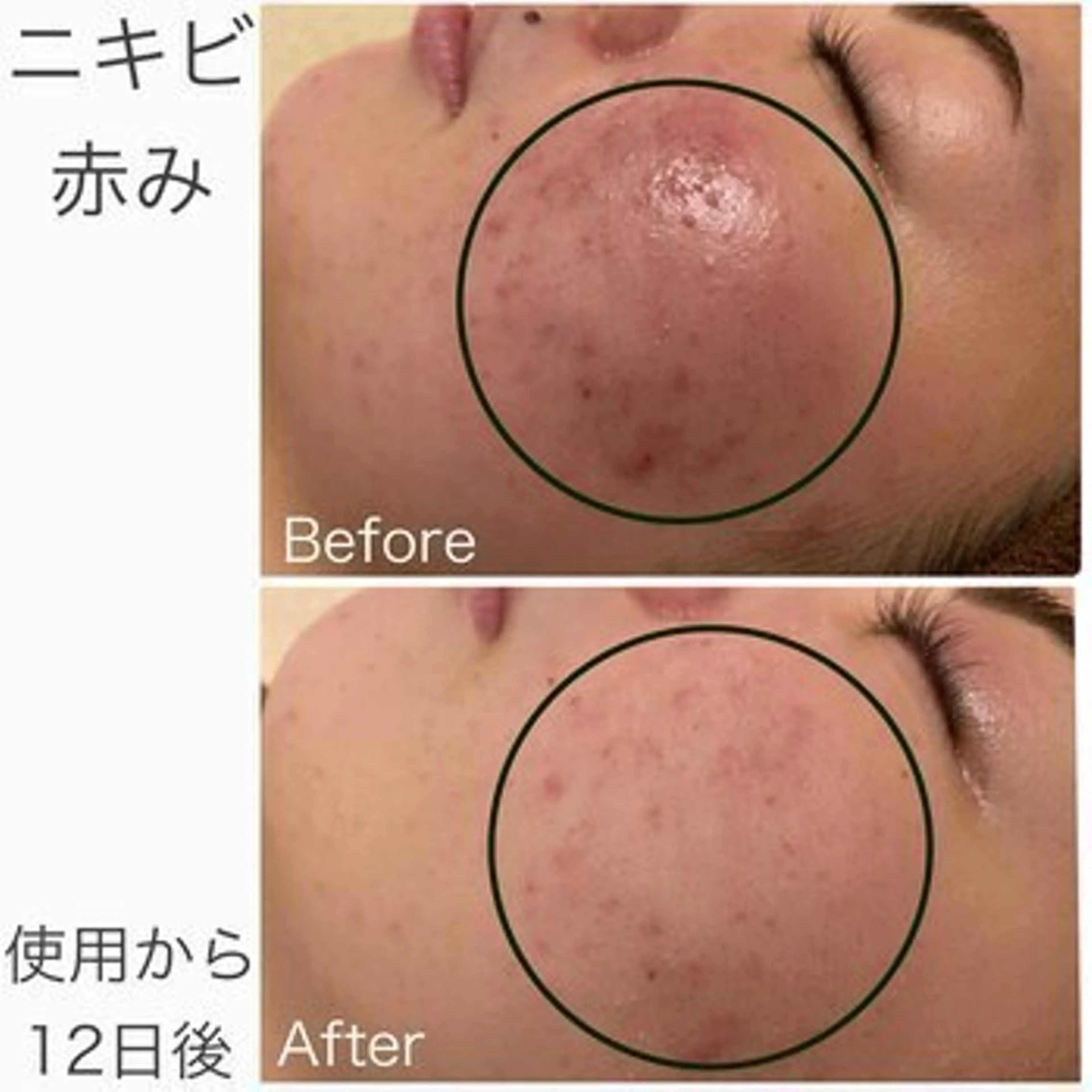 学生ニキビ改善🍀 優しい肌質改善のエステ・リラクイメージ