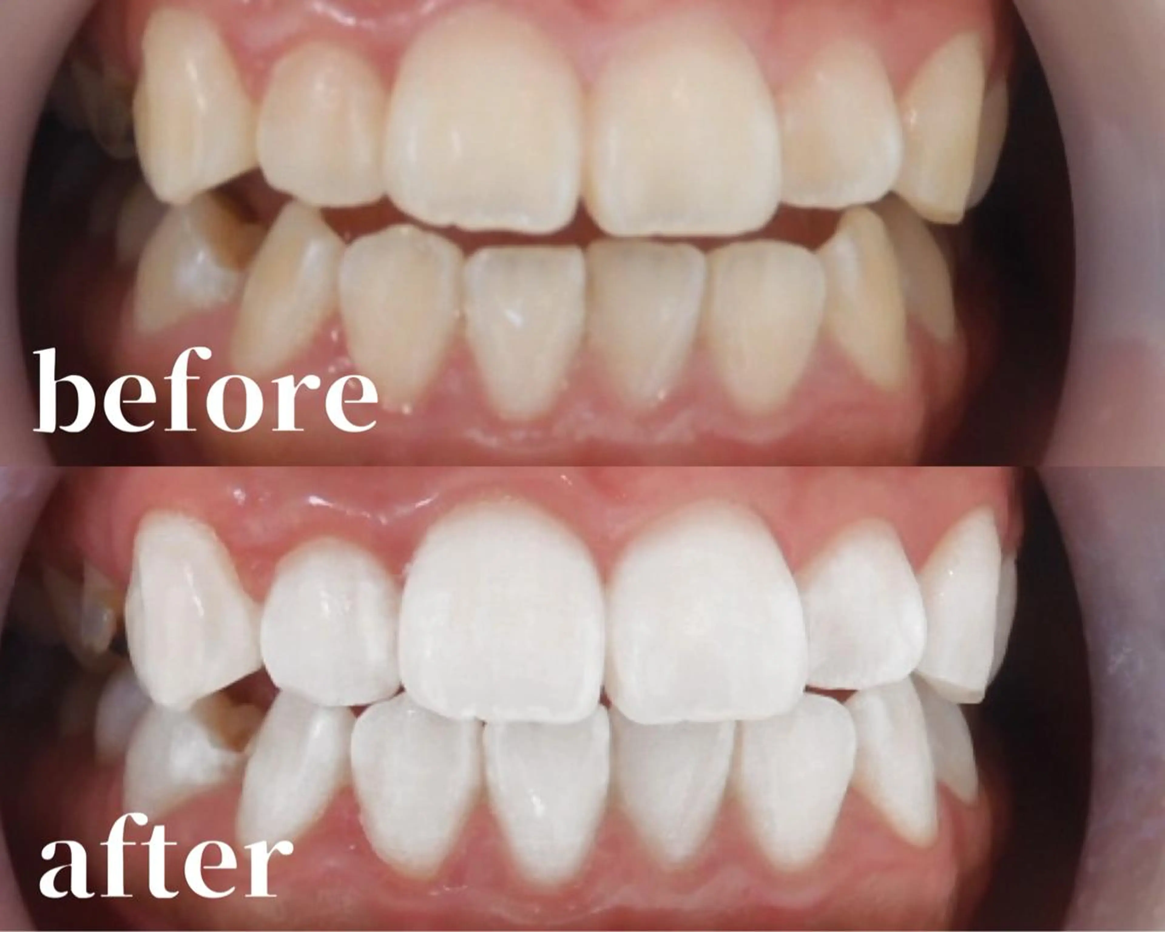 🎀2人でキレイ体験🎀ペア割キャンペーン!プロフェッショナルセルフホワイトニング【15×2】の写真