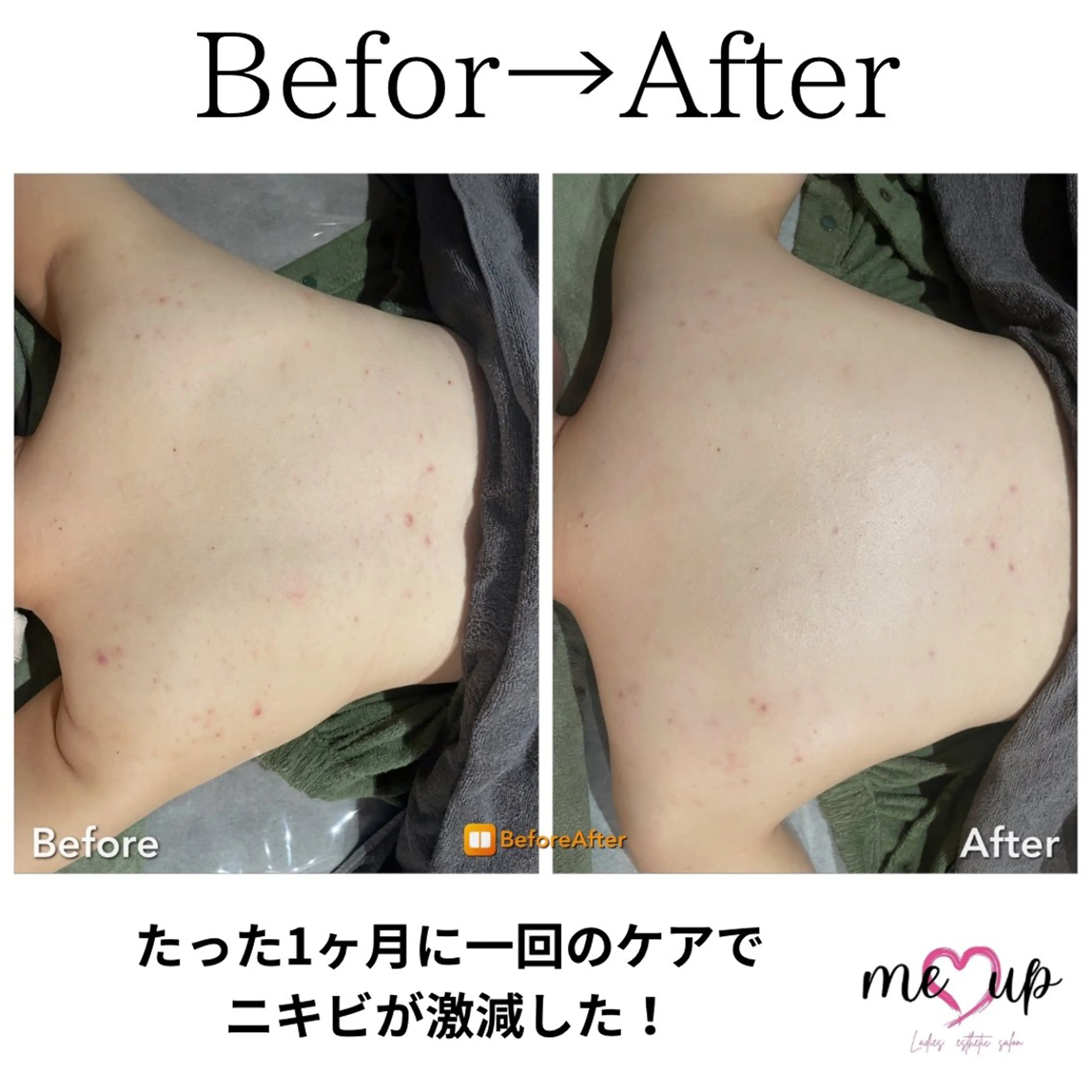 エステ Meupニキビ専門店 背中/ハーブ/肌管理のその他イメージ