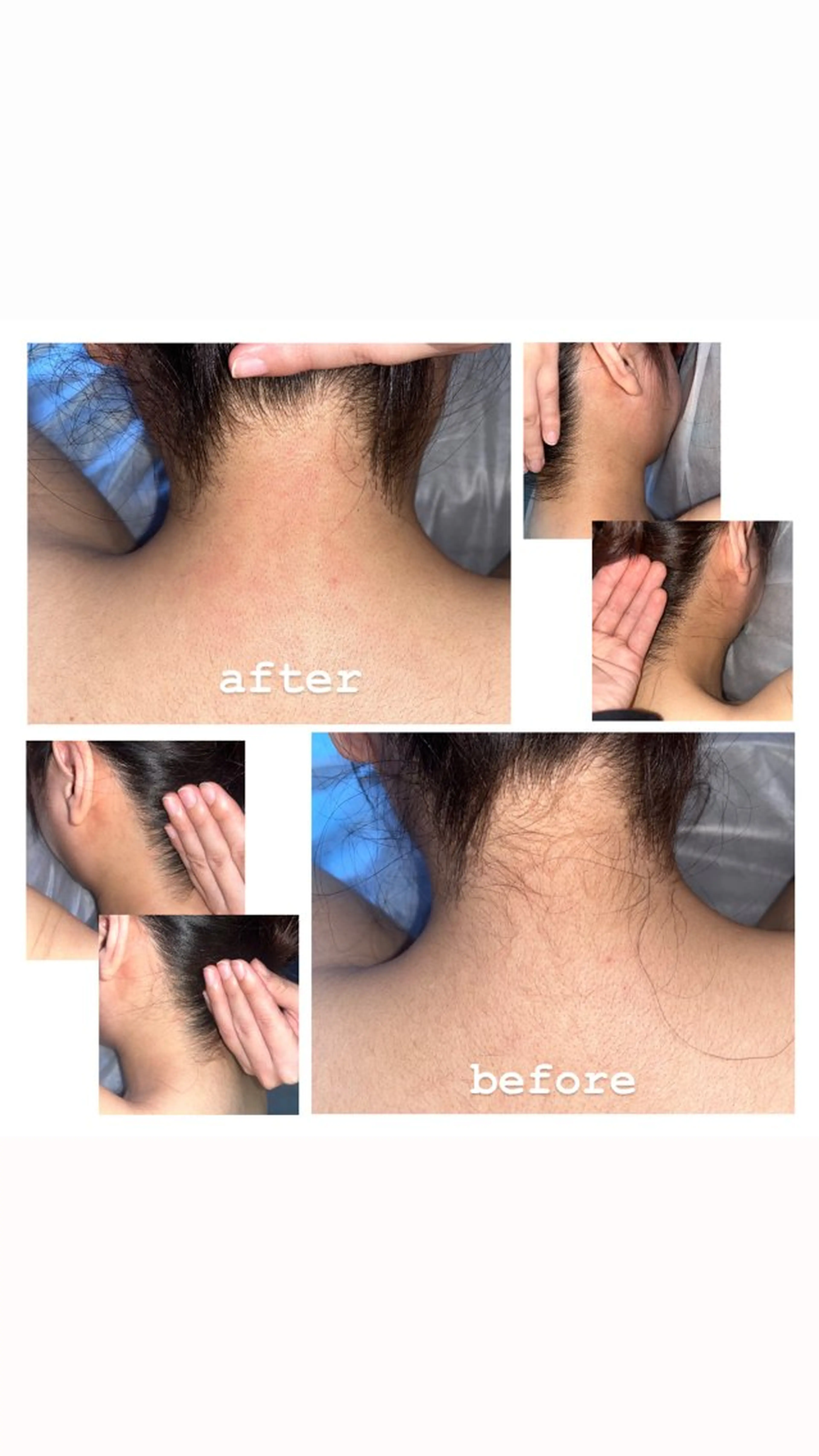 💙レディースお顔　脱毛🤍体験の写真