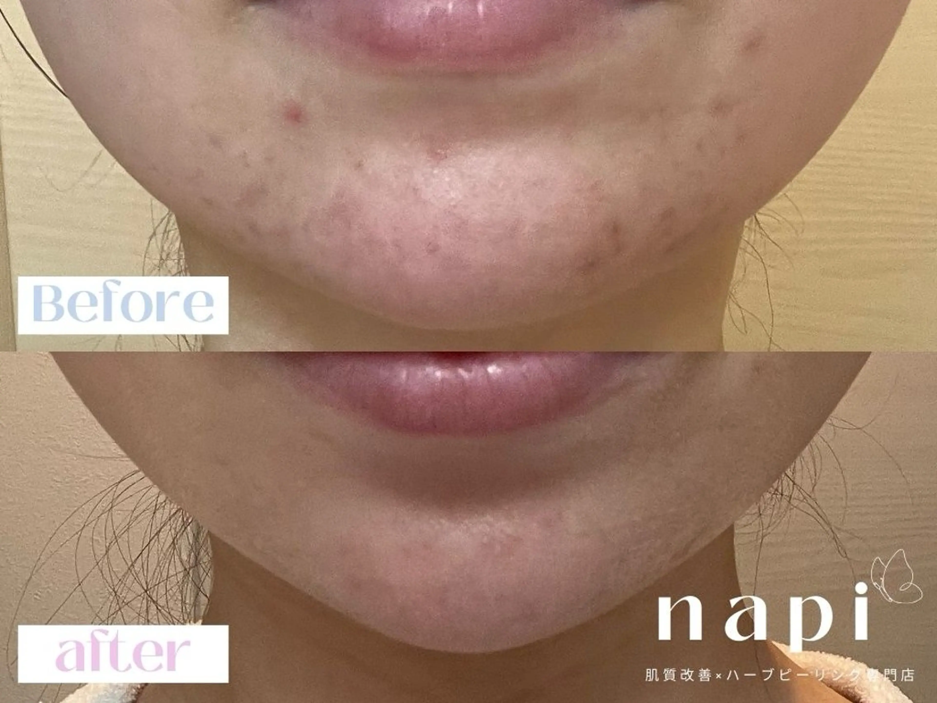 ハーブピーリング 専門店napiのエステ・リラクイメージ