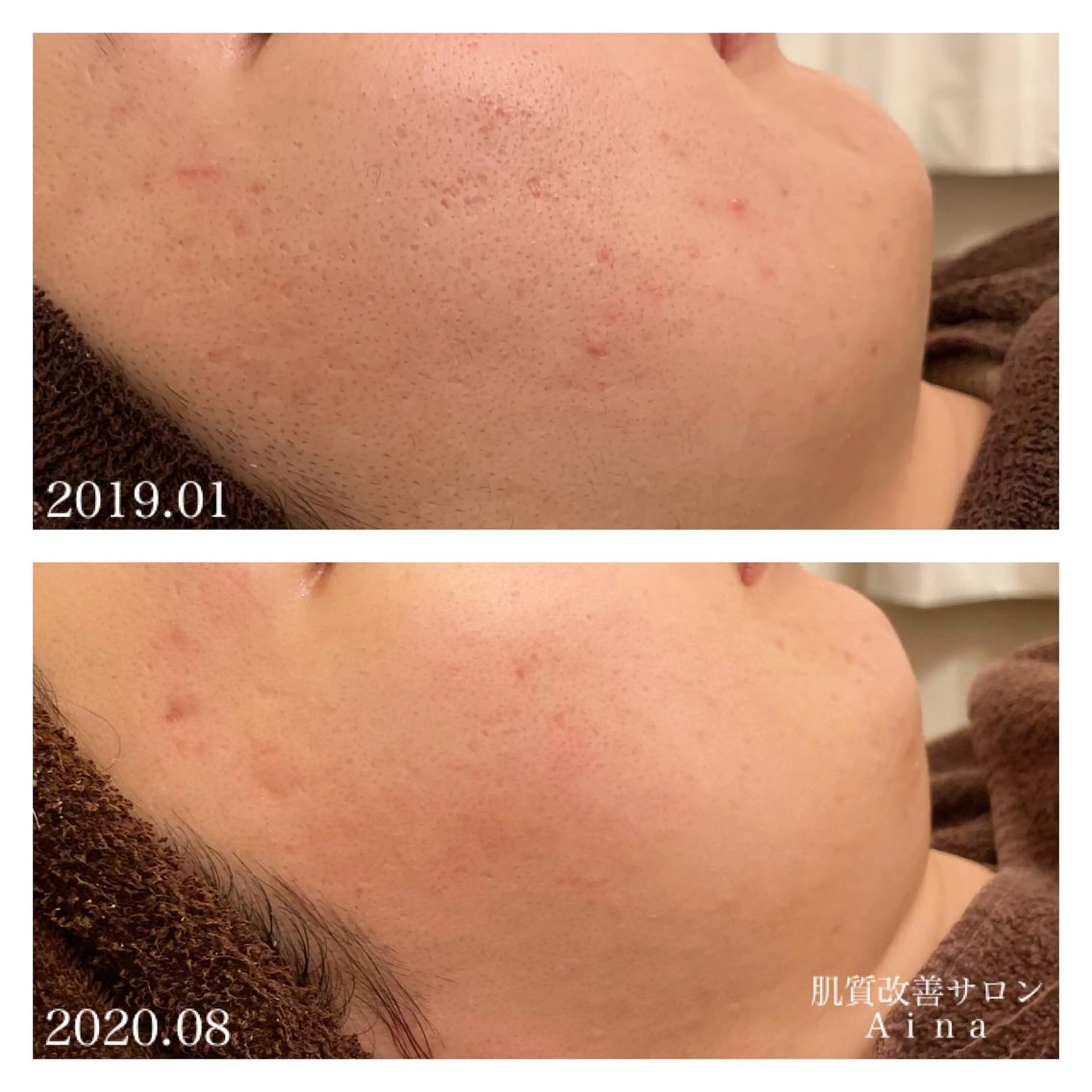 ミディアム カラー パーマ ヘアアレンジ メンズ キッズ ネイル マツエク・マツパ 学生（メンズ向け） 学生 ニキビ跡専門サロン Ａｉｎａのエステ・リラクイメージ