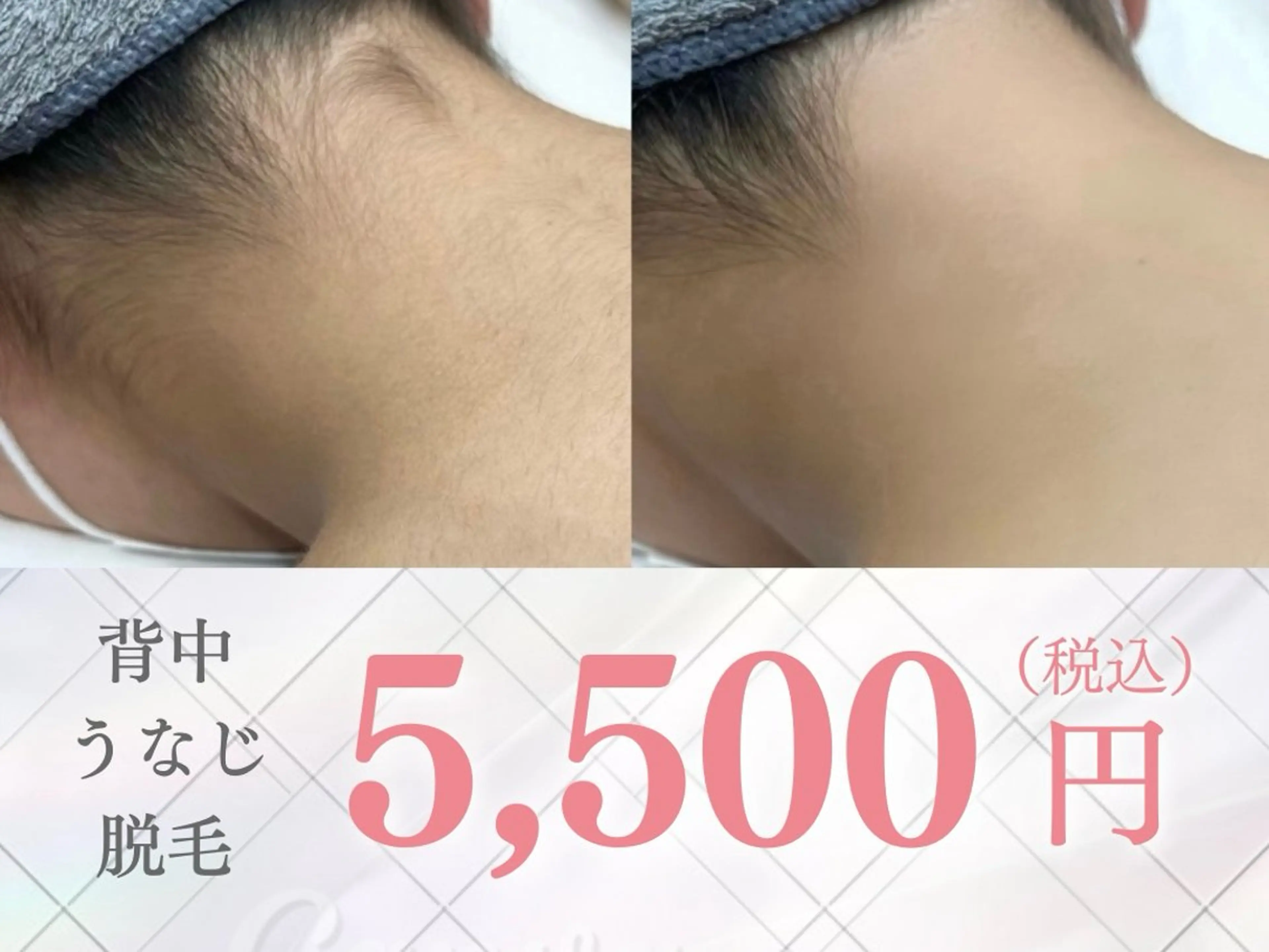 【脱毛】次世代脱毛でツルツル美肌＜最新DPL式脱毛＞背中/うなじ¥5,500の写真