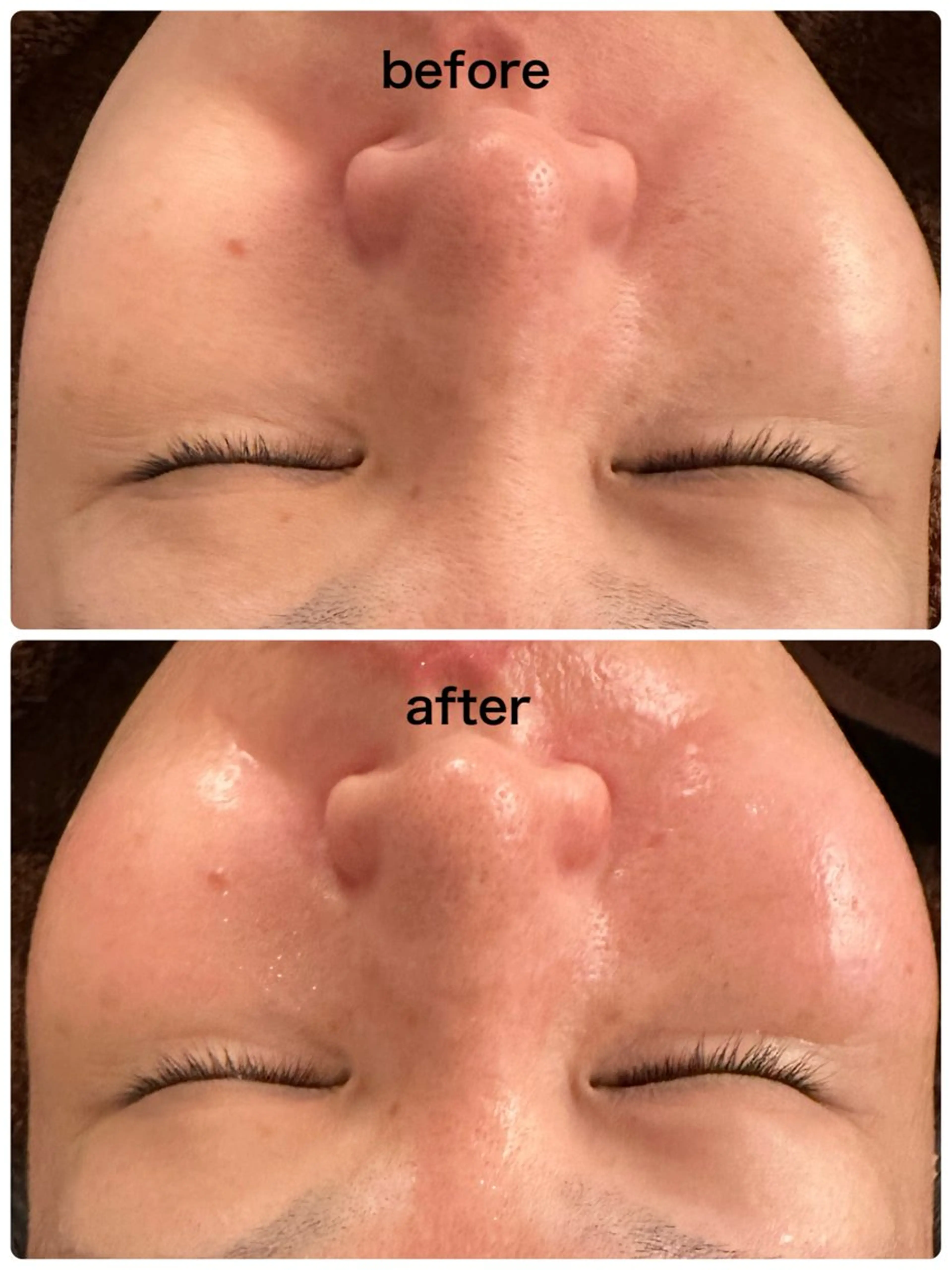 即効効果クリスマス限定本日中のみ【WiQo水光ピール×保湿パック付】最新美容＊即効ツヤ/ハリ。どこよりも最安値になりますの写真