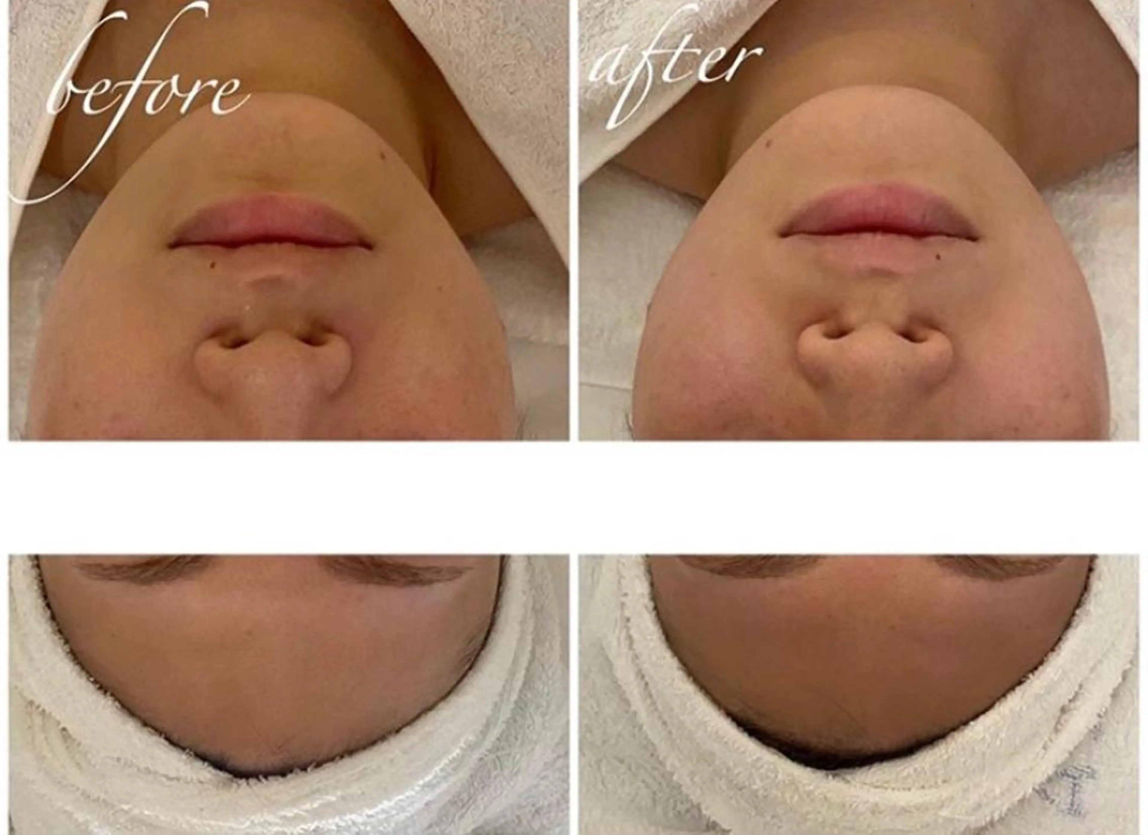 エステ リラク 毛穴/ピーリング ララピール/POLAのエステ・リラクイメージ