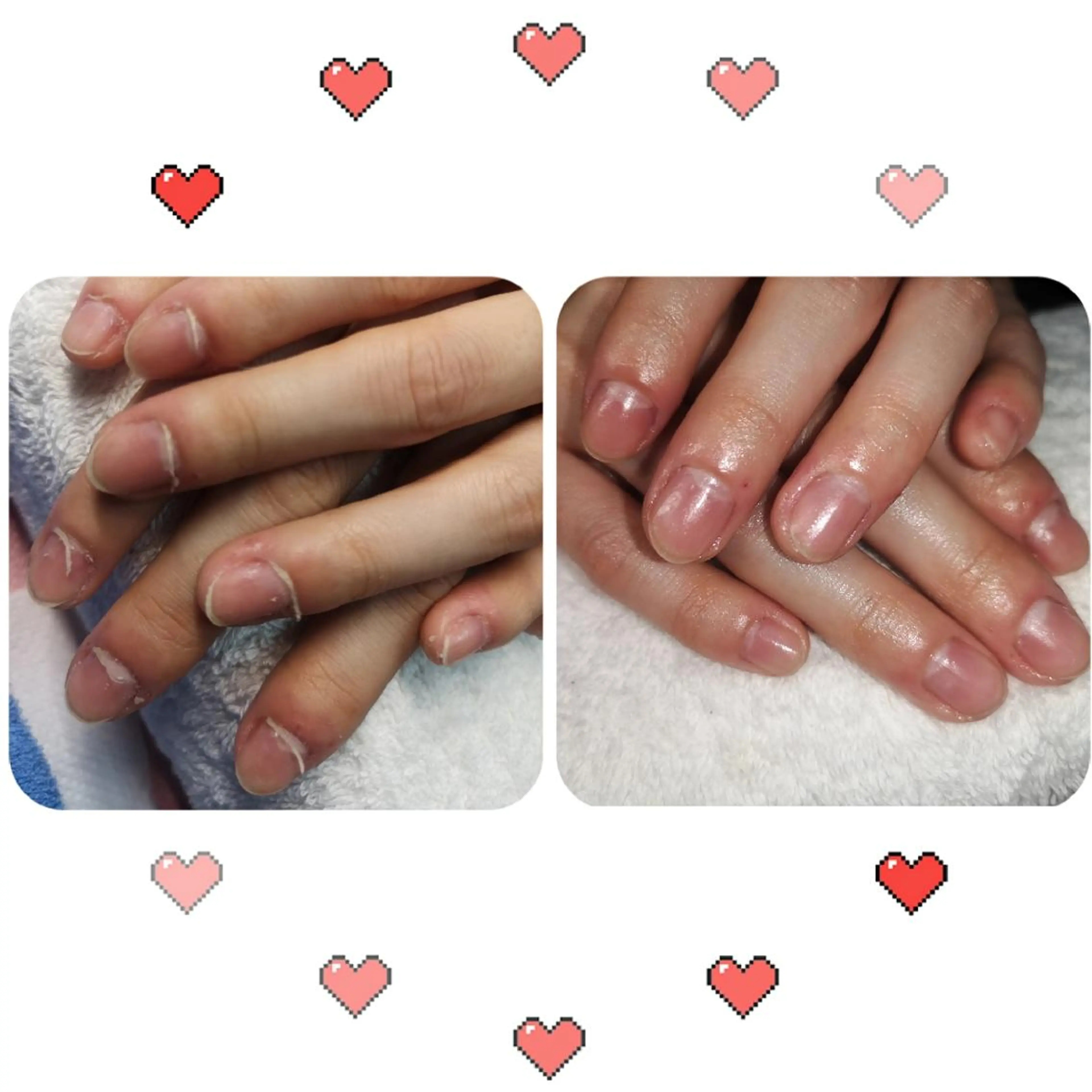 ショート ネイル ネイリストゆか💅 長さだし、深爪矯正のネイルデザイン