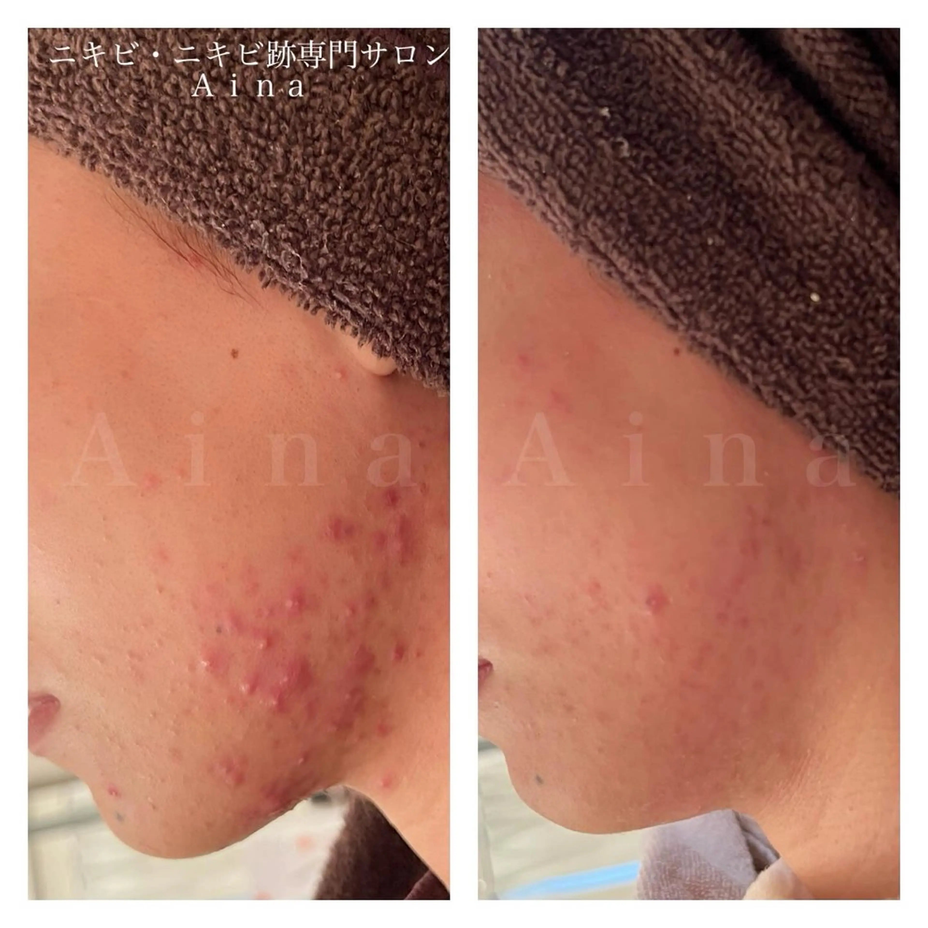 エステ リラク ニキビ跡専門サロン Ａｉｎａのエステ・リラクイメージ
