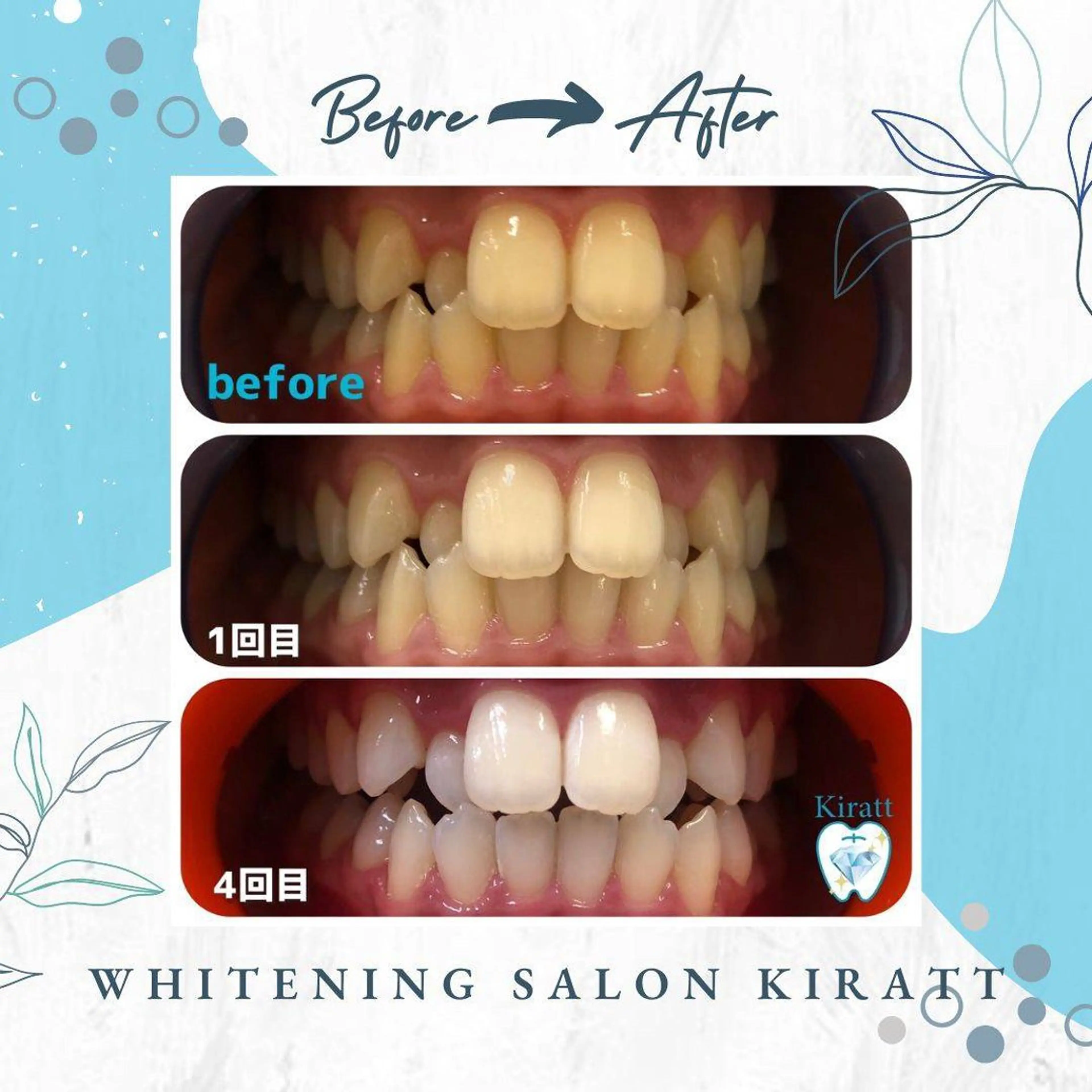 セルフホワイトニングサロンKiratt札幌店💎所属・Kiratt 札幌店のその他イメージ