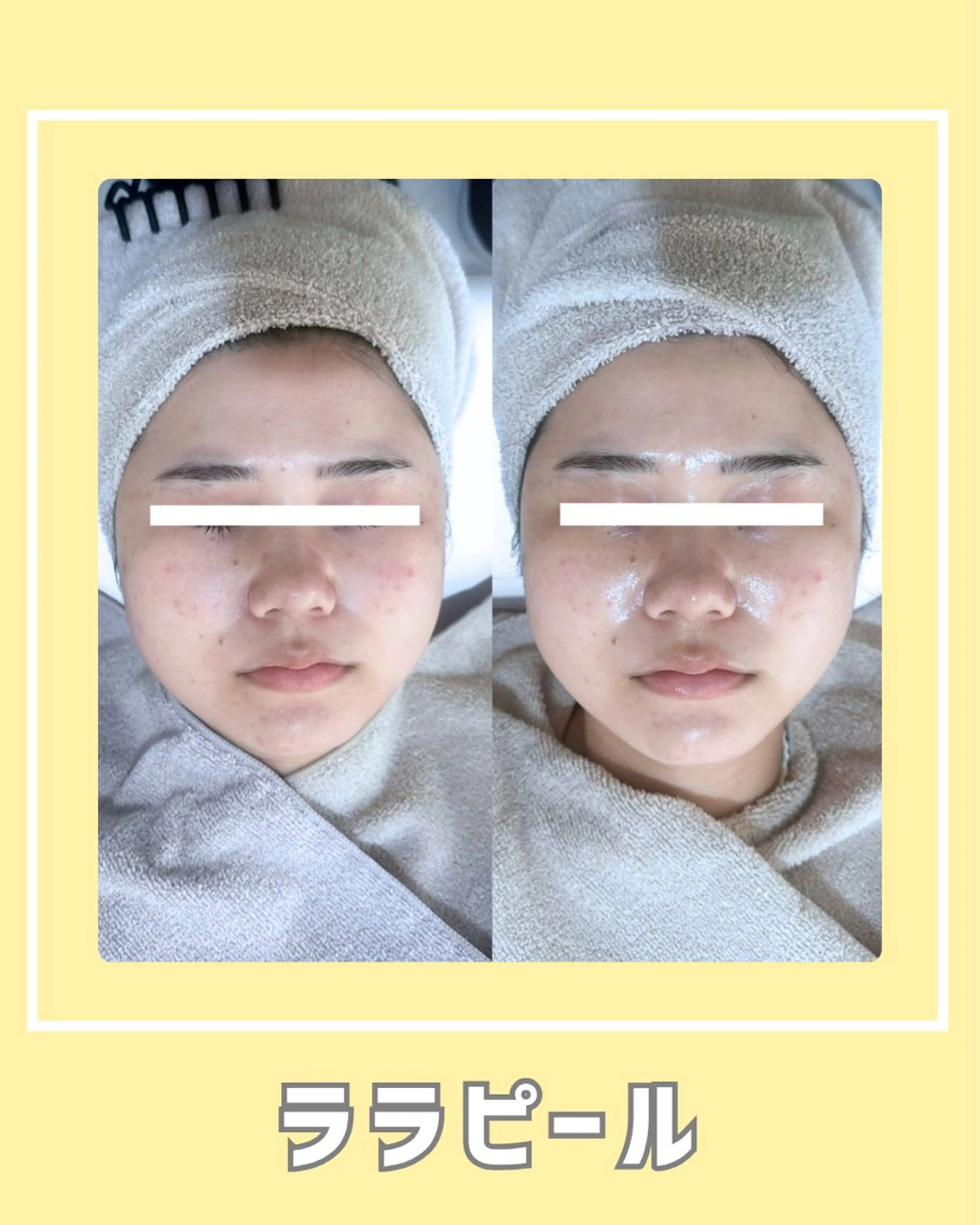 エステ |ピーリング・毛穴| soina神楽坂のエステ・リラクイメージ