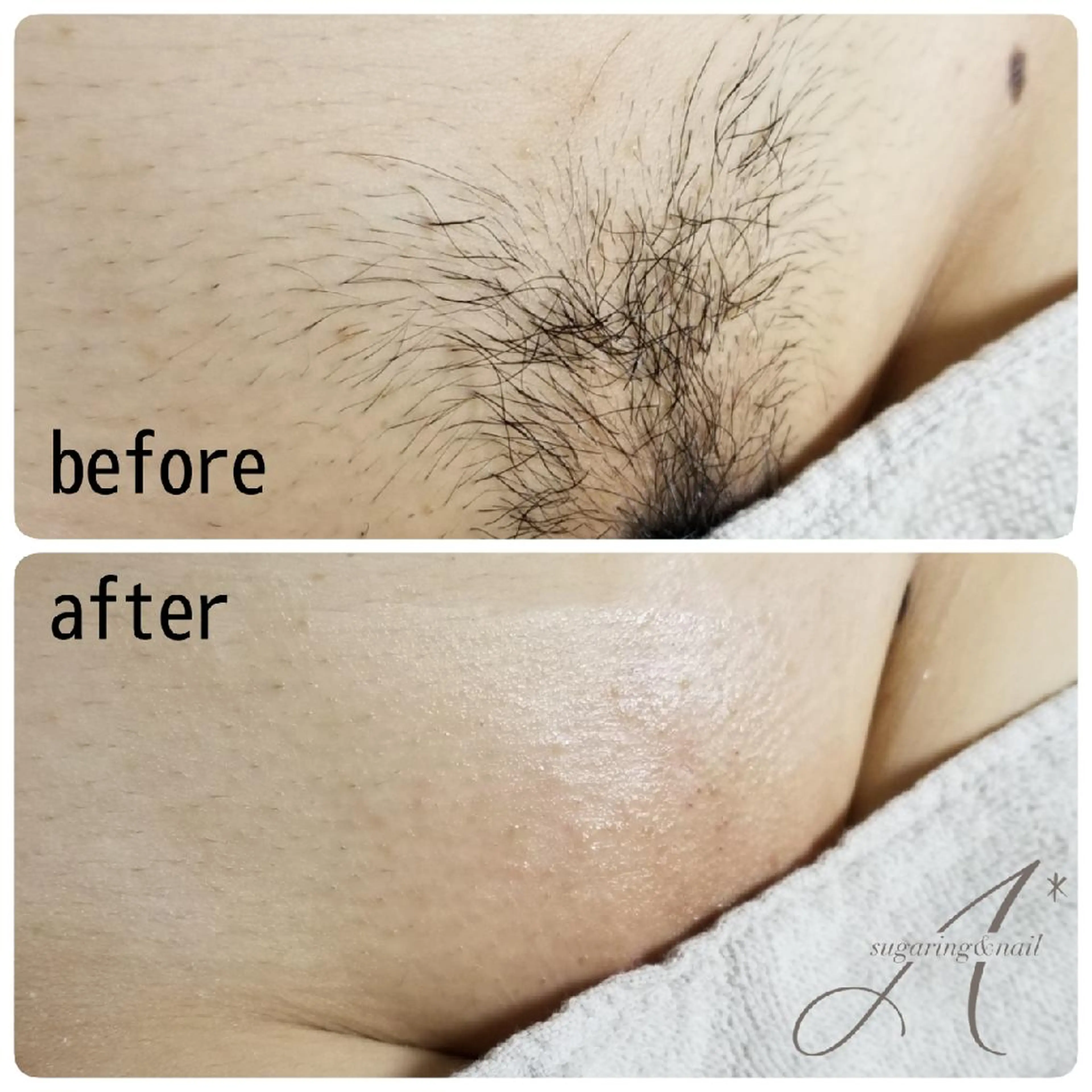 A*[エースター] シュガーリング🍋のエステ・リラクイメージ