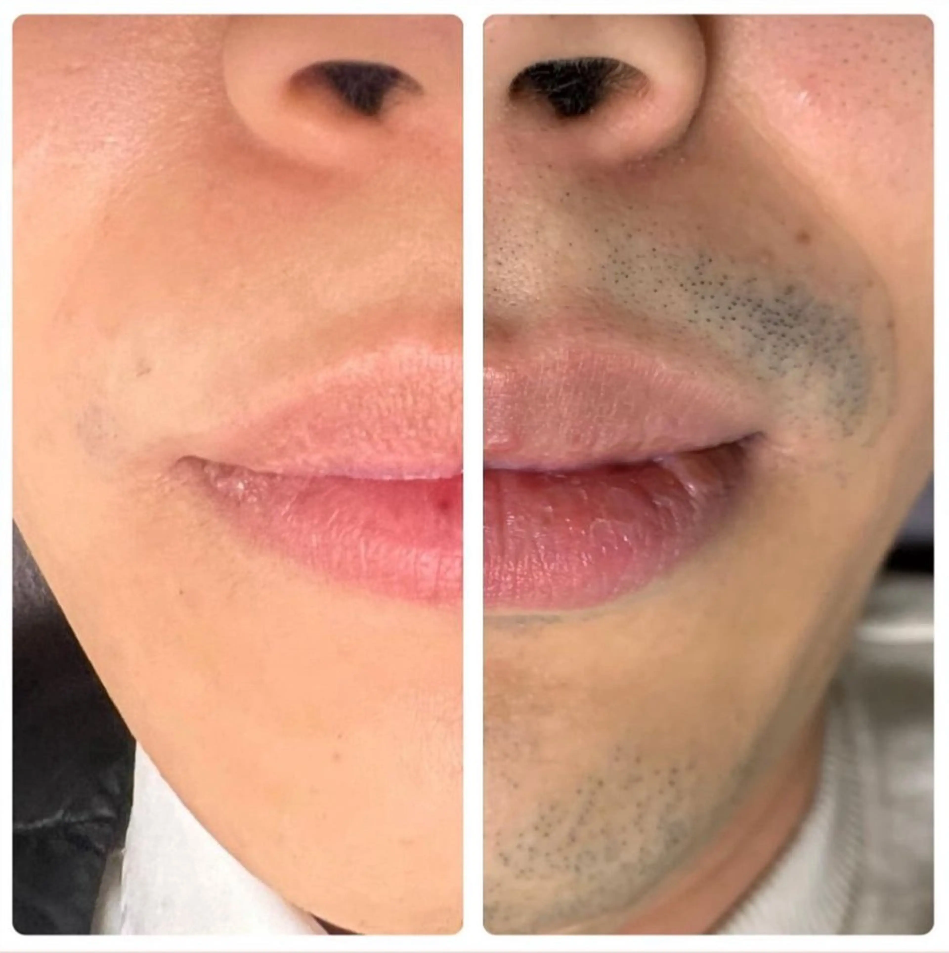 【ご新規様限定】おヒゲ①パーツ脱毛の写真